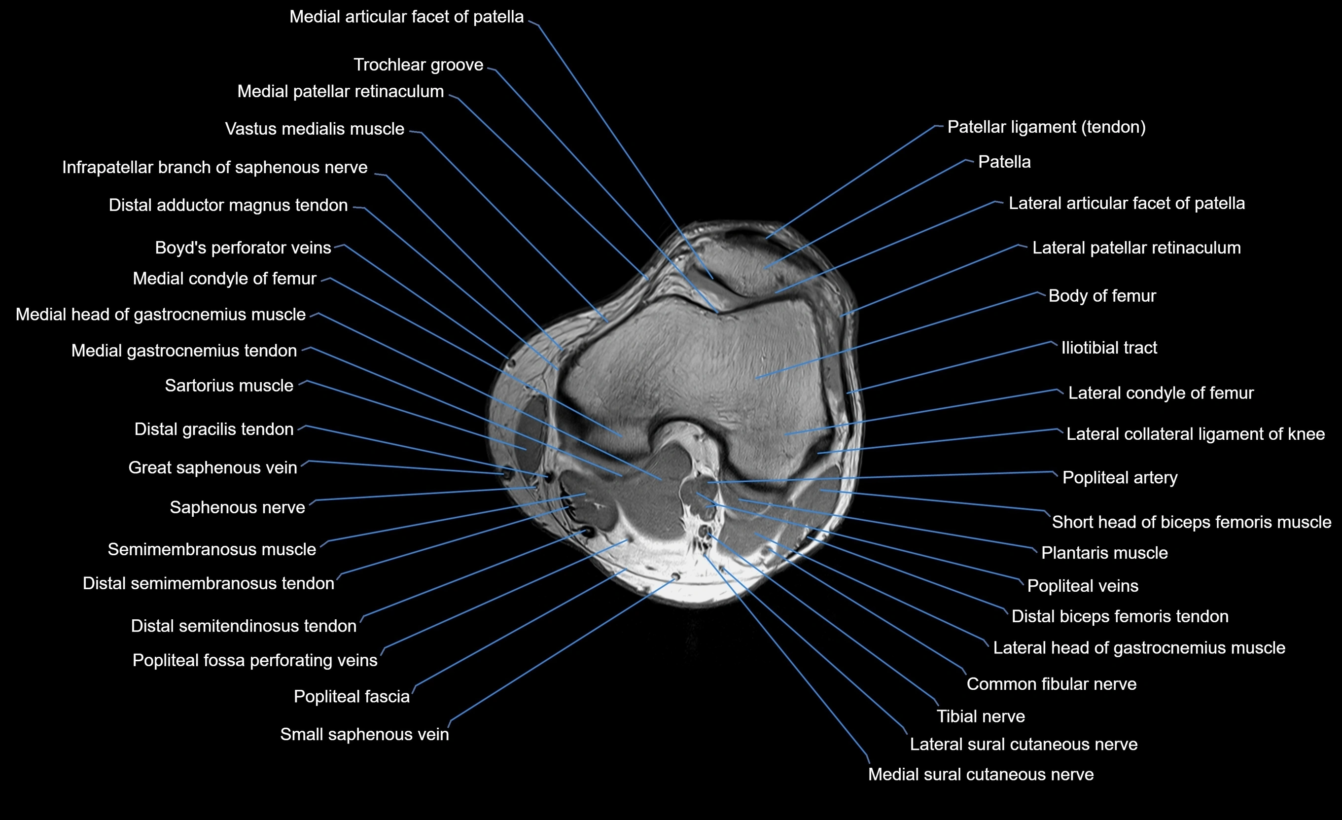 MRI Lower Leg Anatomy – Normal MRI, Labeled Axial, Coronal & Sagittal ...