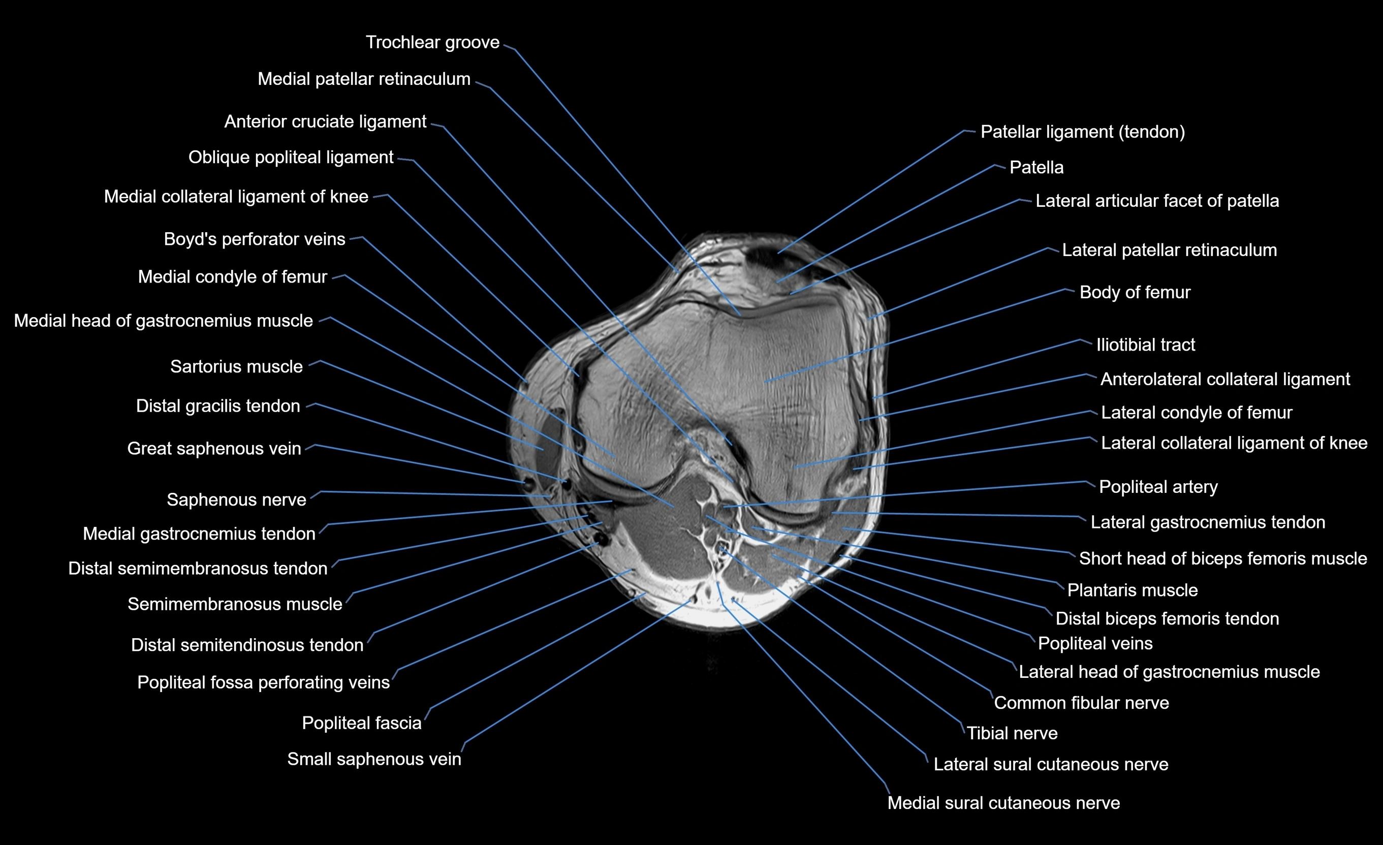 MRI Lower Leg Anatomy – Normal MRI, Labeled Axial, Coronal & Sagittal ...