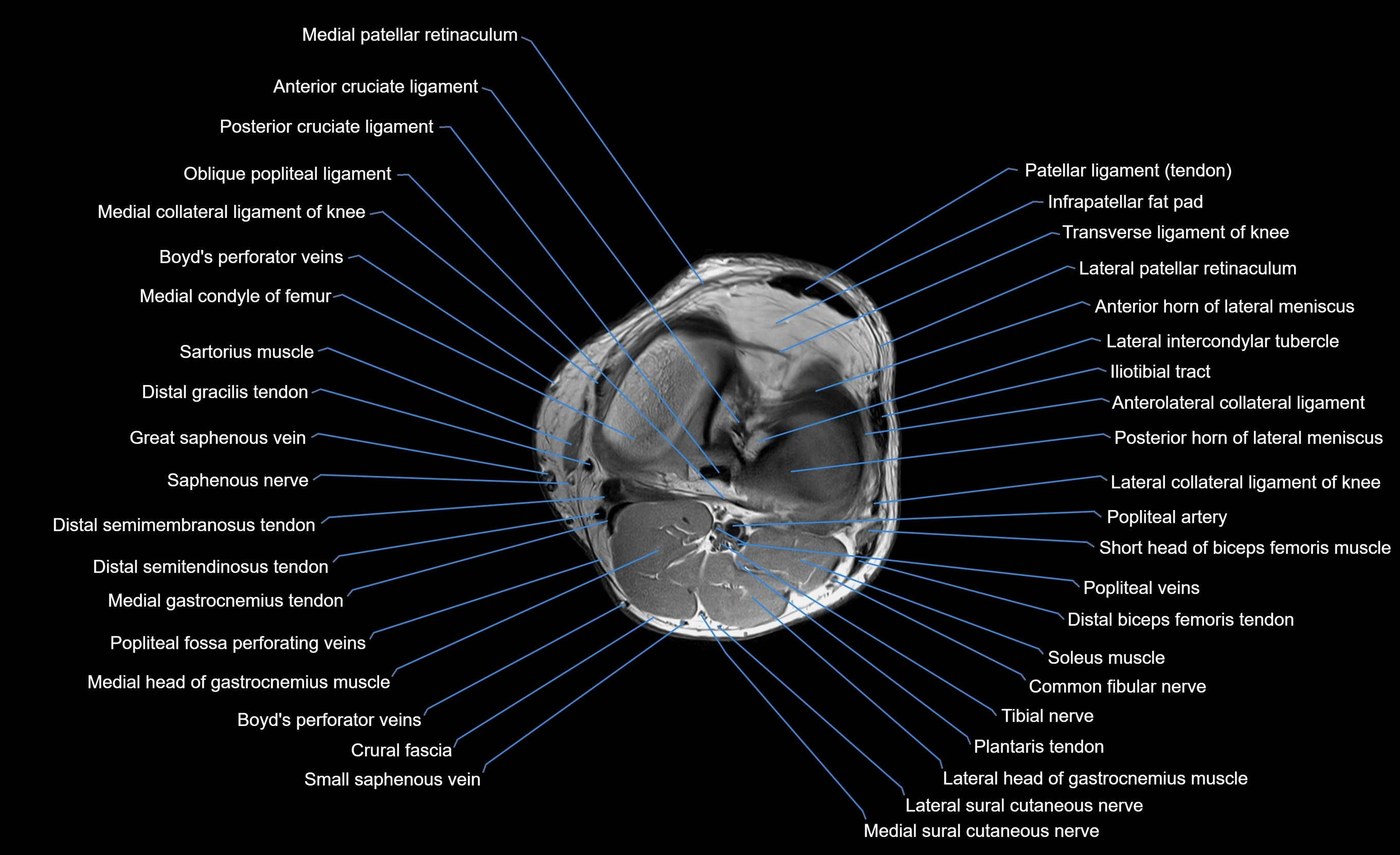 MRI Lower Leg Anatomy – Normal MRI, Labeled Axial, Coronal & Sagittal ...