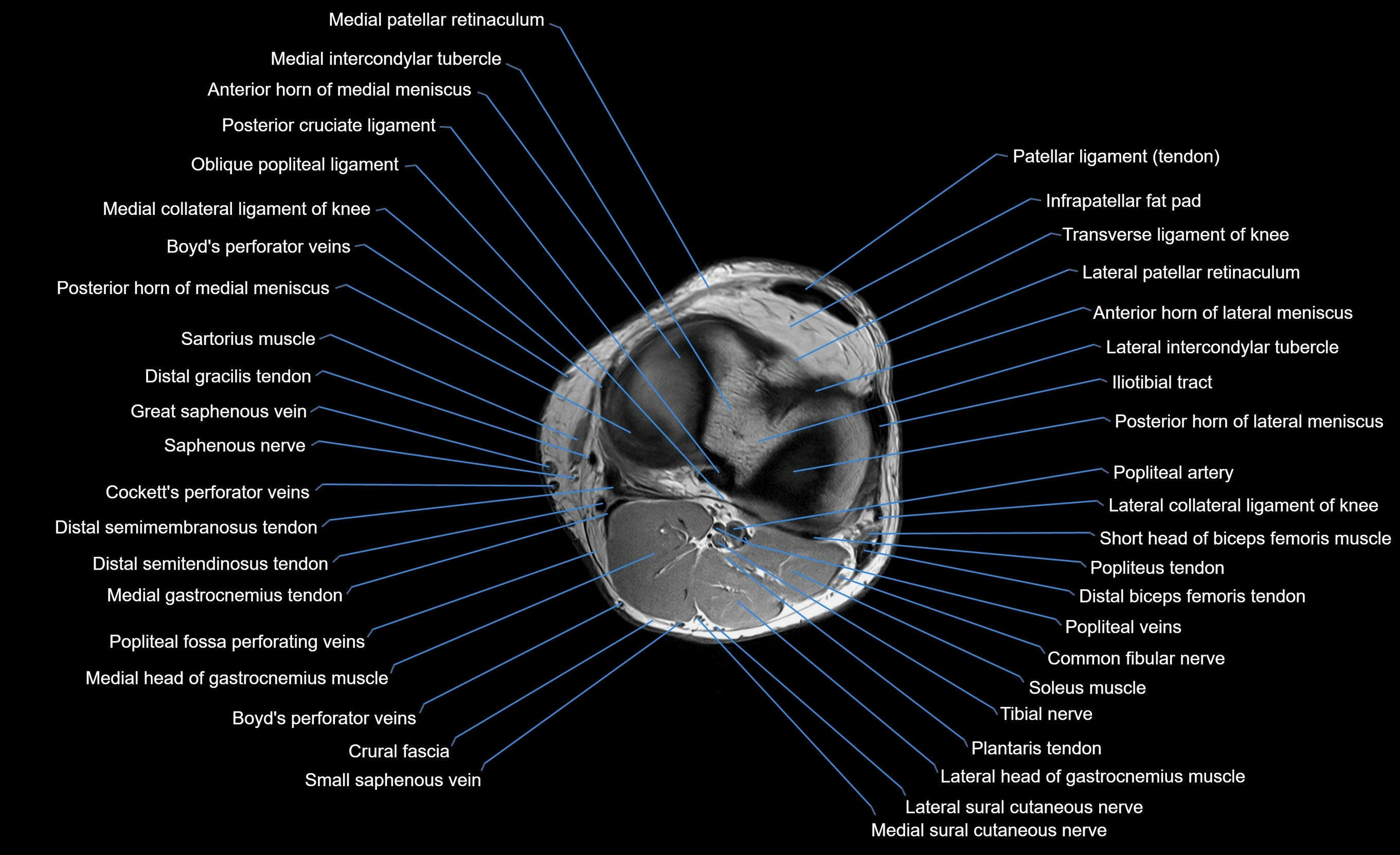 MRI Lower Leg Anatomy – Normal MRI, Labeled Axial, Coronal & Sagittal ...