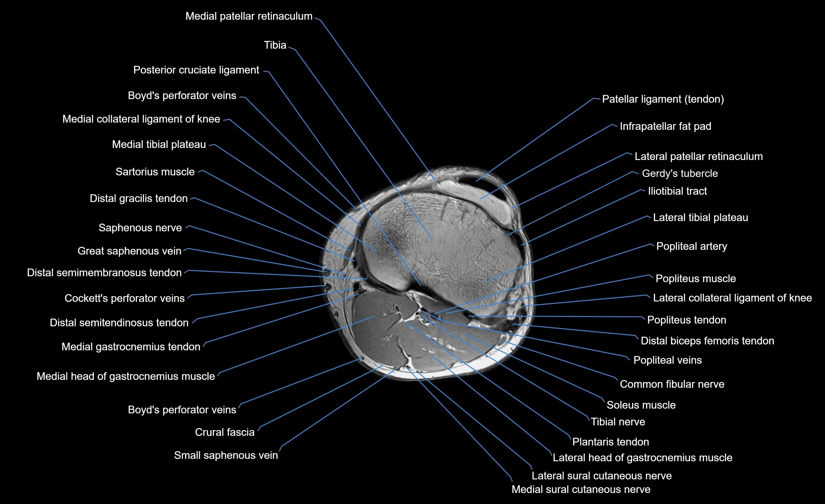 MRI Lower Leg Anatomy – Normal MRI, Labeled Axial, Coronal & Sagittal ...