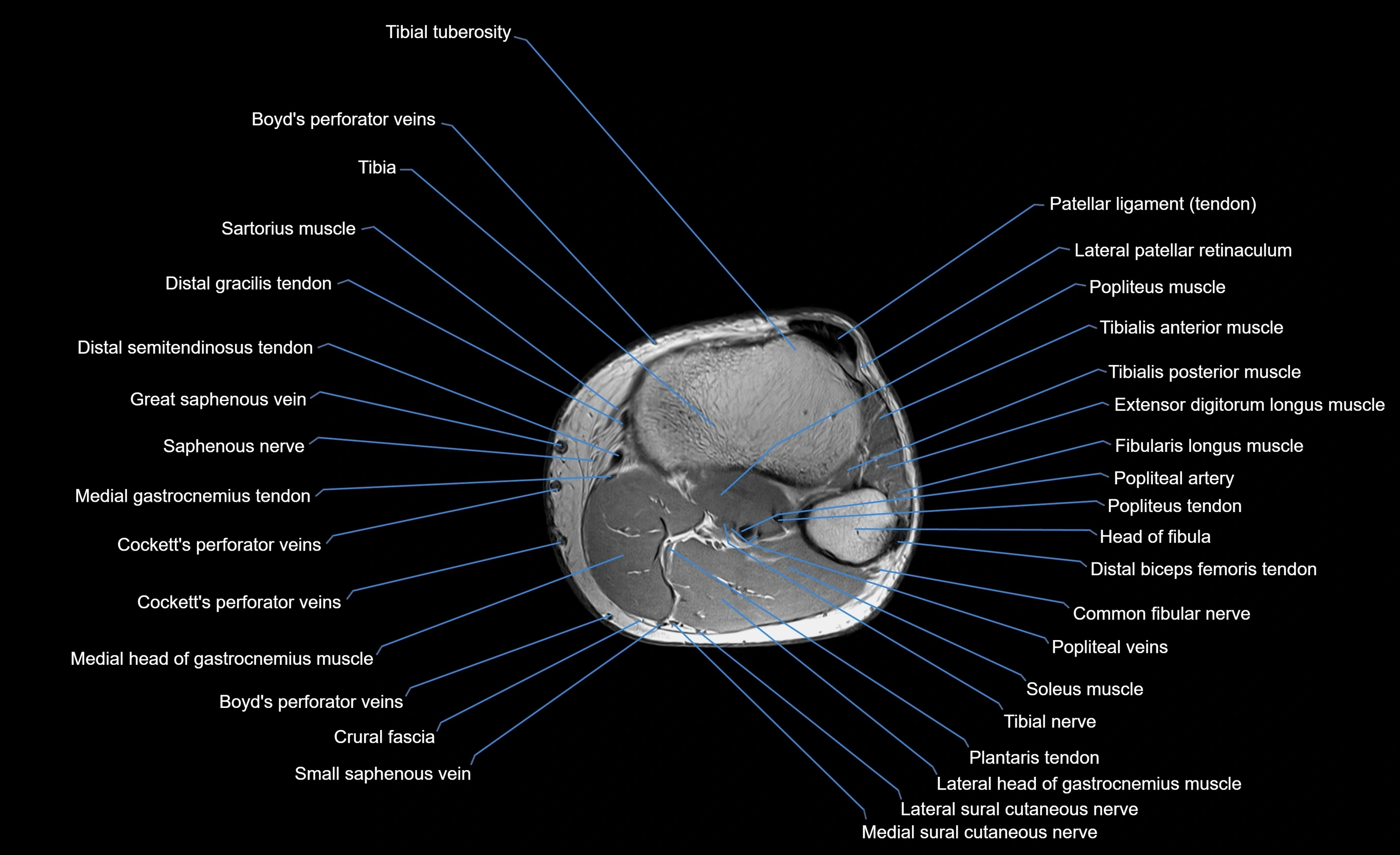MRI Lower Leg Anatomy – Normal MRI, Labeled Axial, Coronal & Sagittal ...