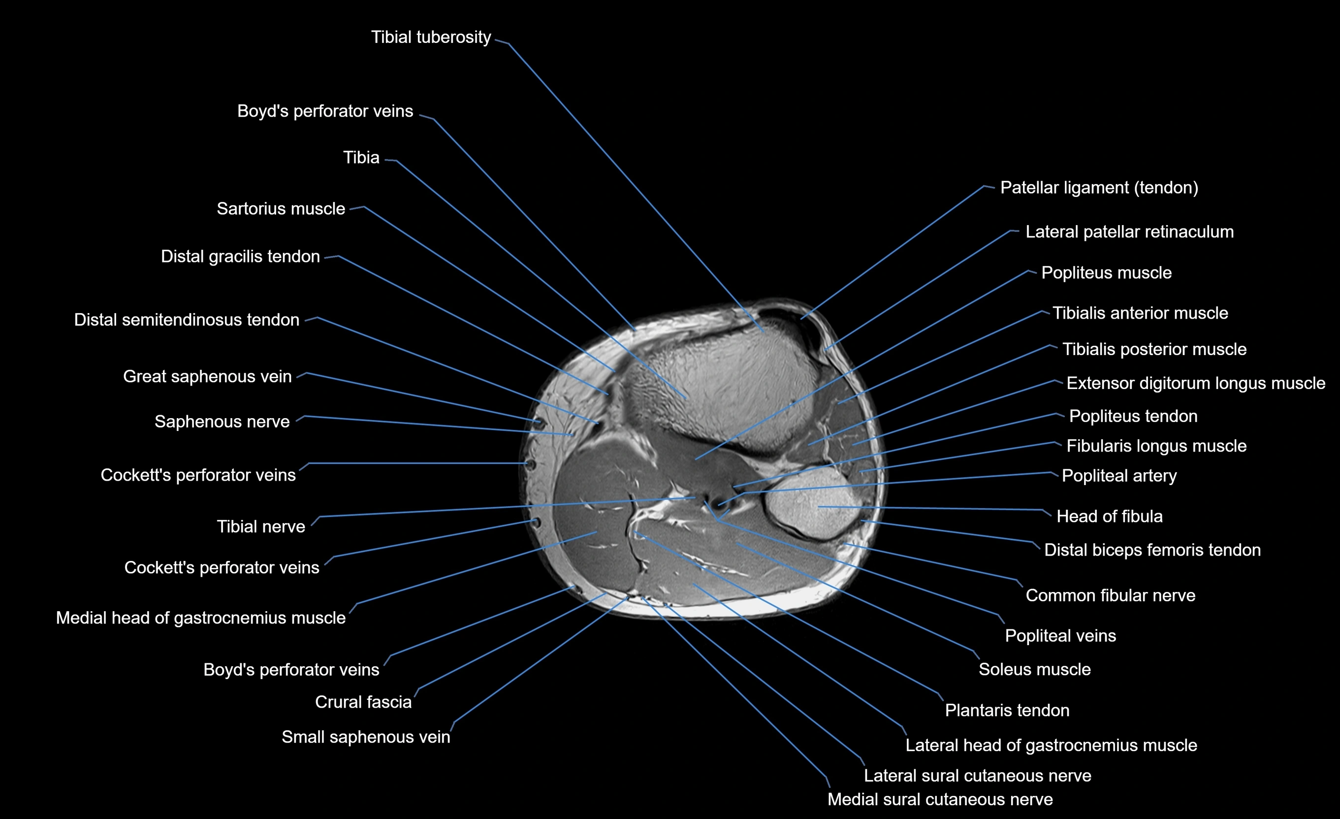 MRI Lower Leg Anatomy – Normal MRI, Labeled Axial, Coronal & Sagittal ...