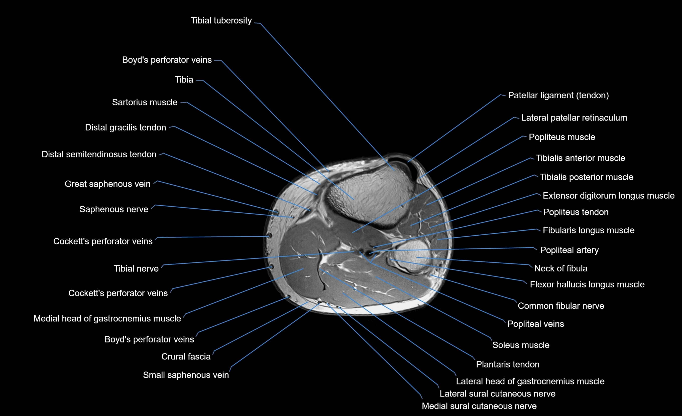 MRI Lower Leg Anatomy – Normal MRI, Labeled Axial, Coronal & Sagittal ...