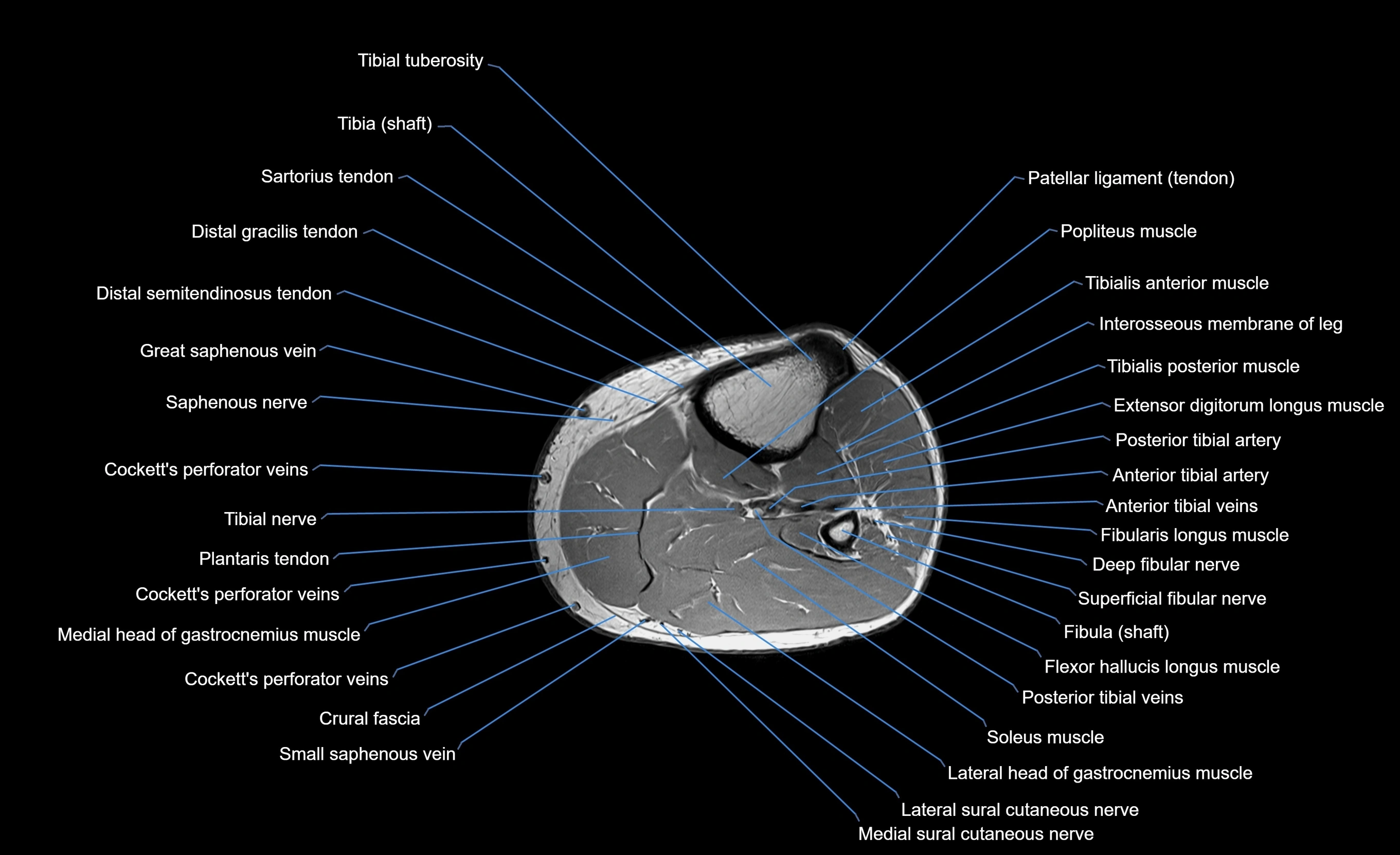 MRI Lower Leg Anatomy – Normal MRI, Labeled Axial, Coronal & Sagittal ...