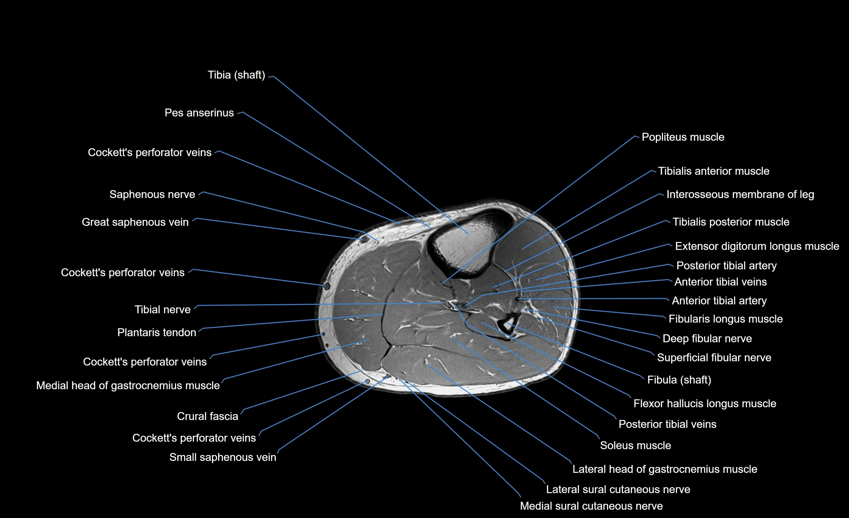 MRI Lower Leg Anatomy – Normal MRI, Labeled Axial, Coronal & Sagittal ...