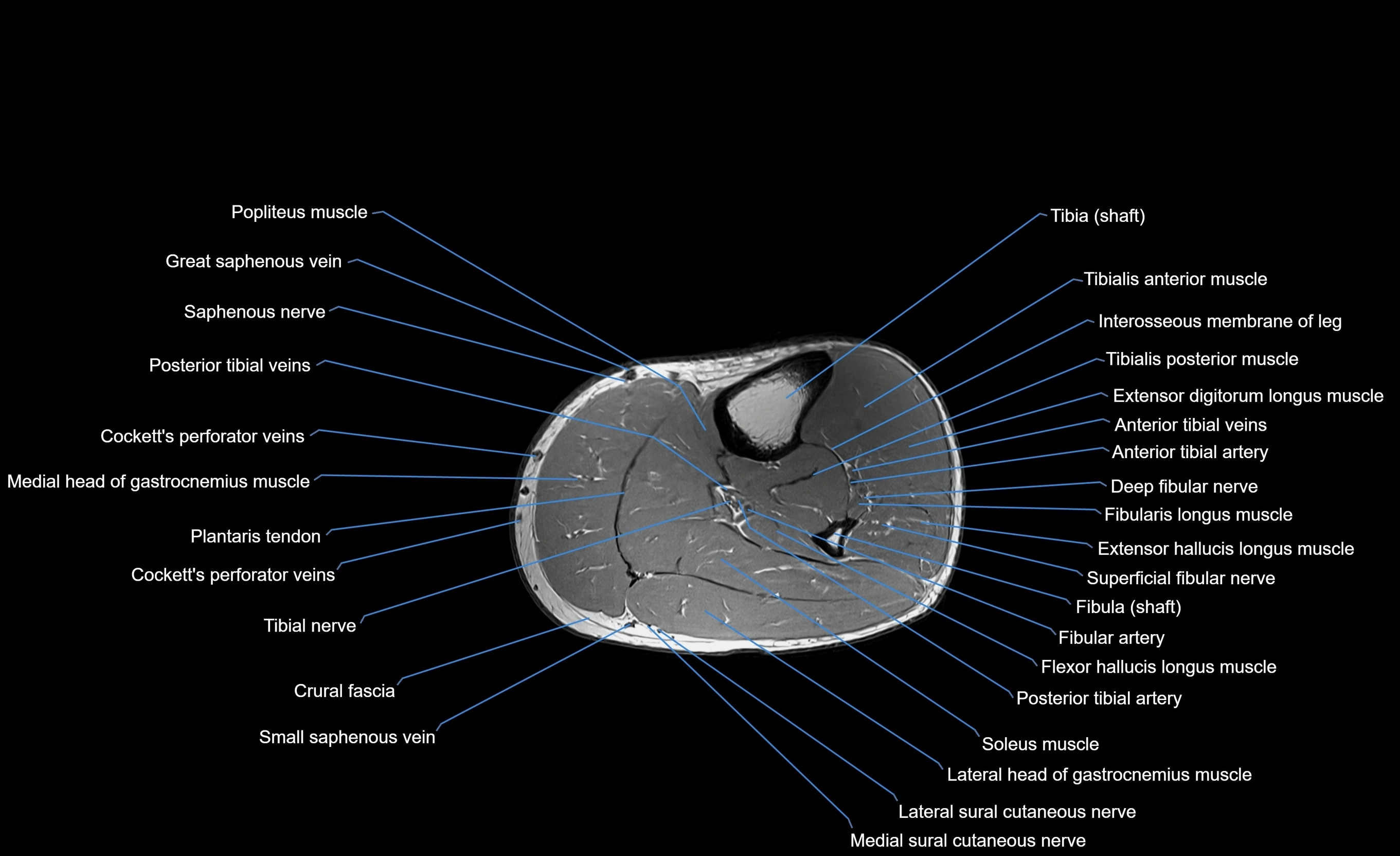 MRI Lower Leg Anatomy – Normal MRI, Labeled Axial, Coronal & Sagittal ...