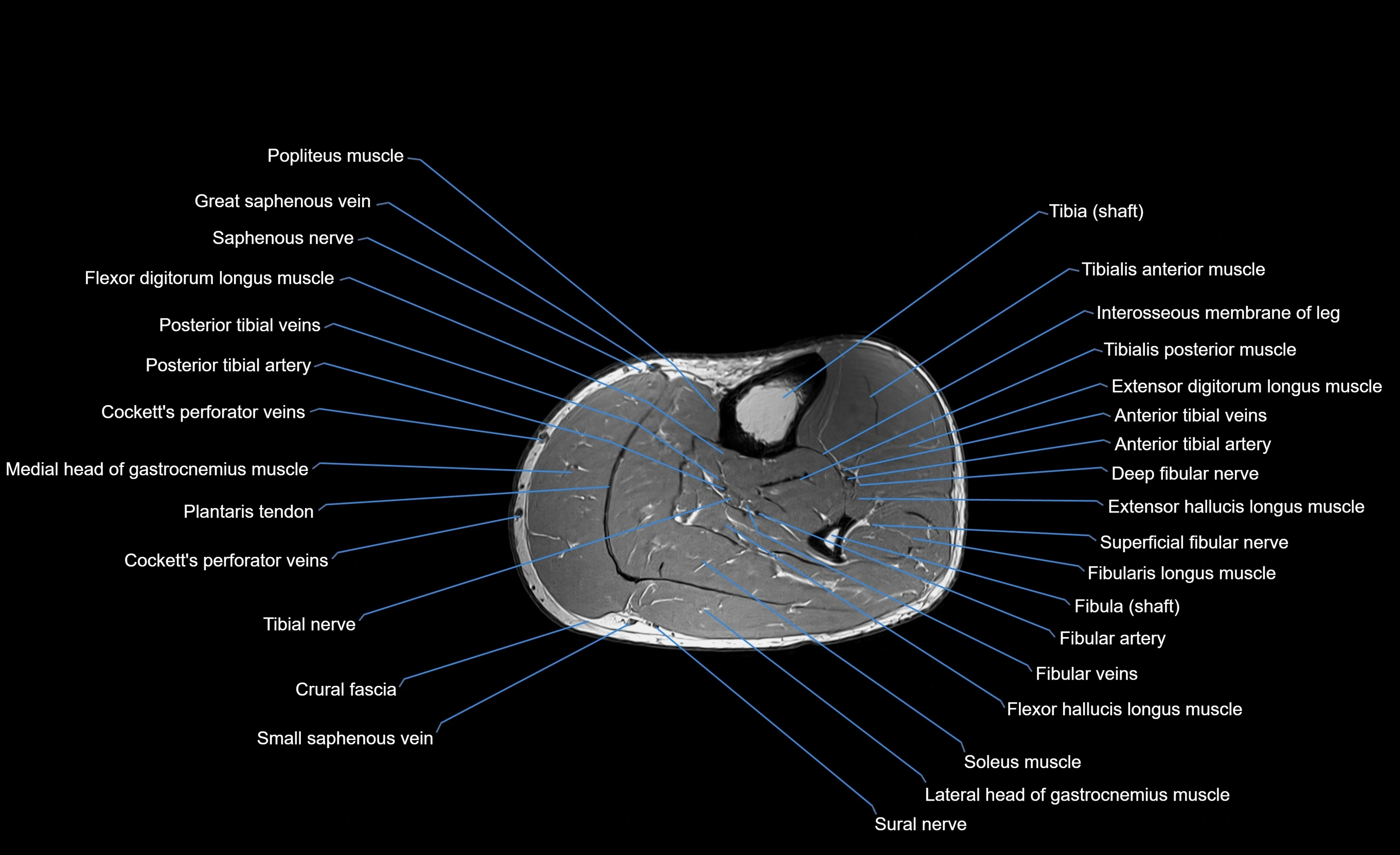 MRI Lower Leg Anatomy – Normal MRI, Labeled Axial, Coronal & Sagittal ...