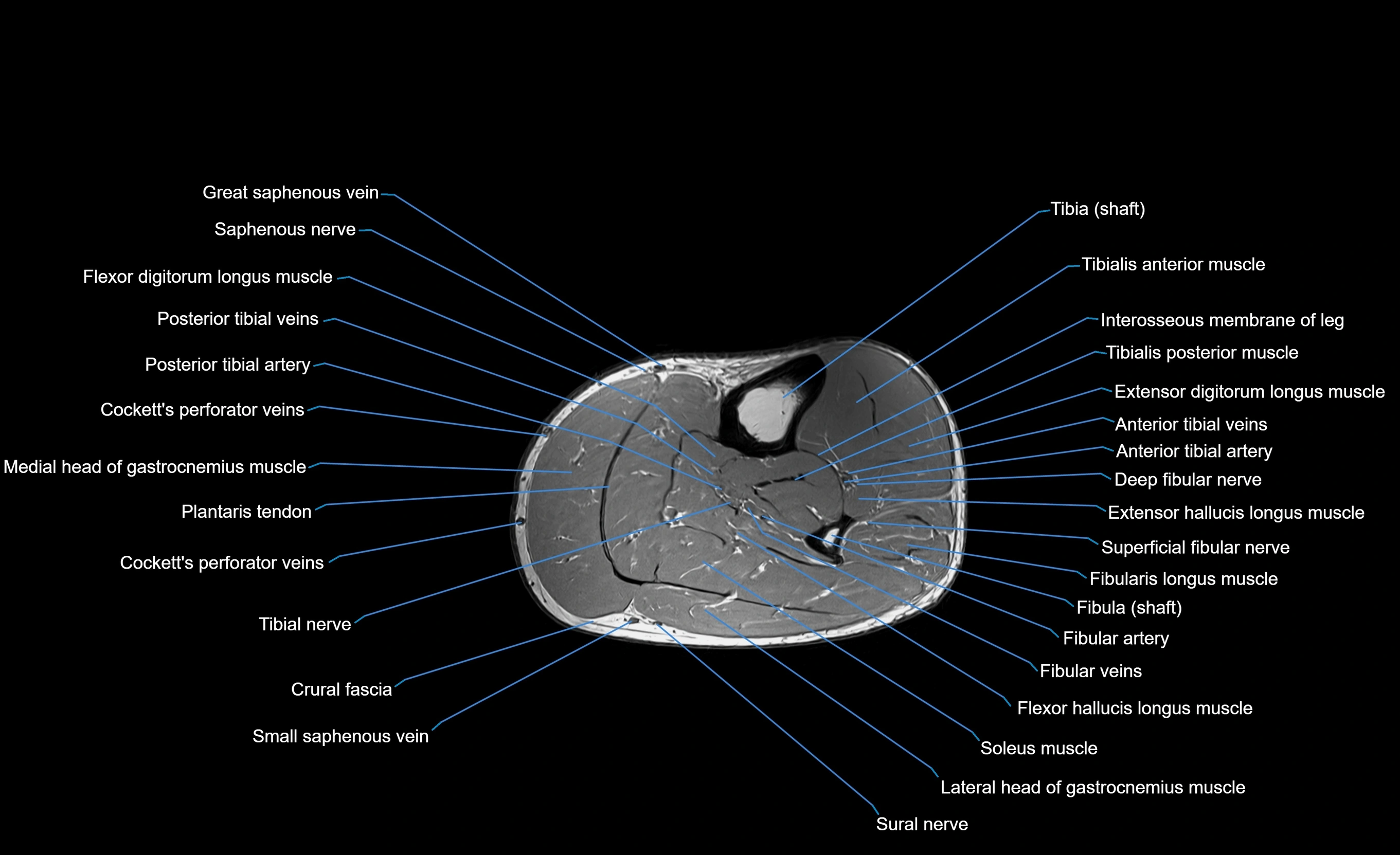 MRI Lower Leg Anatomy – Normal MRI, Labeled Axial, Coronal & Sagittal ...