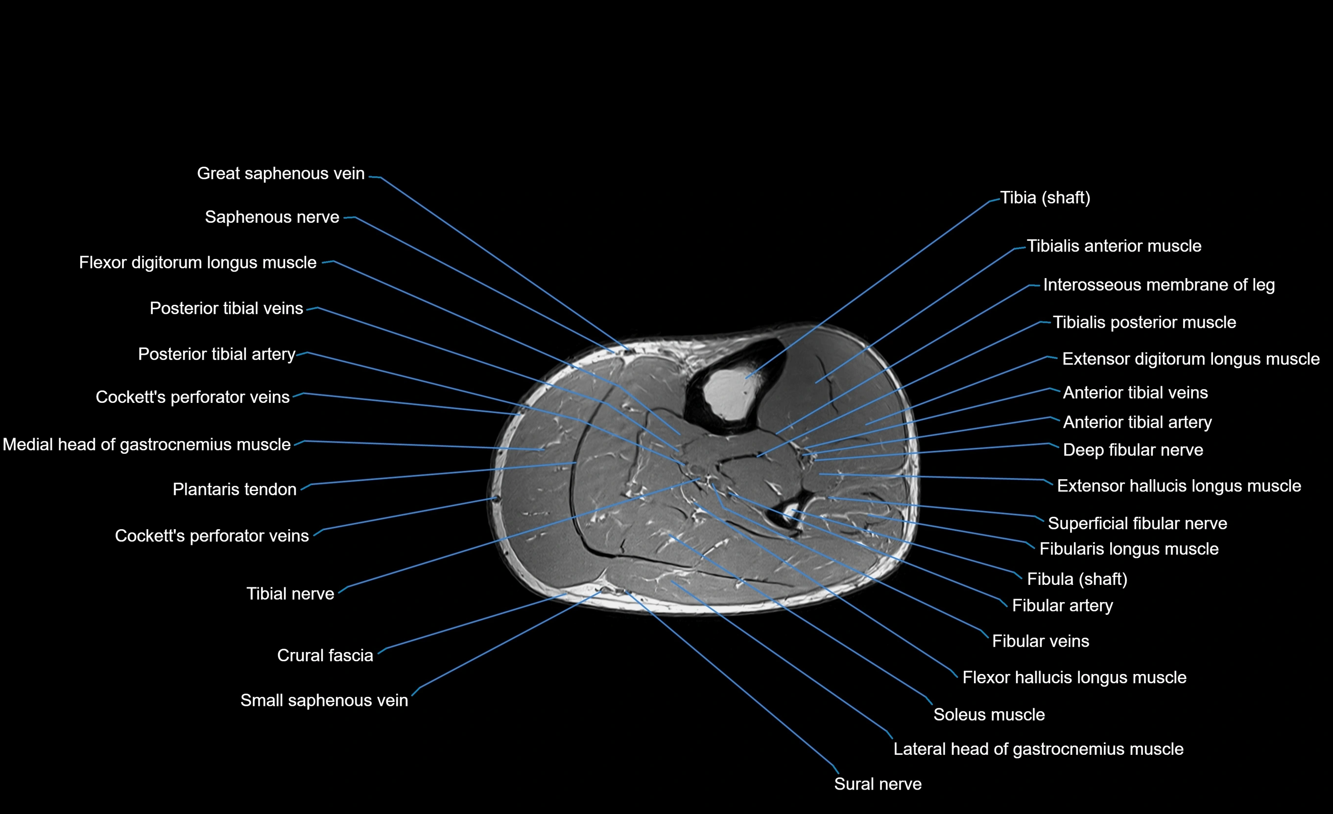 MRI Lower Leg Anatomy – Normal MRI, Labeled Axial, Coronal & Sagittal ...