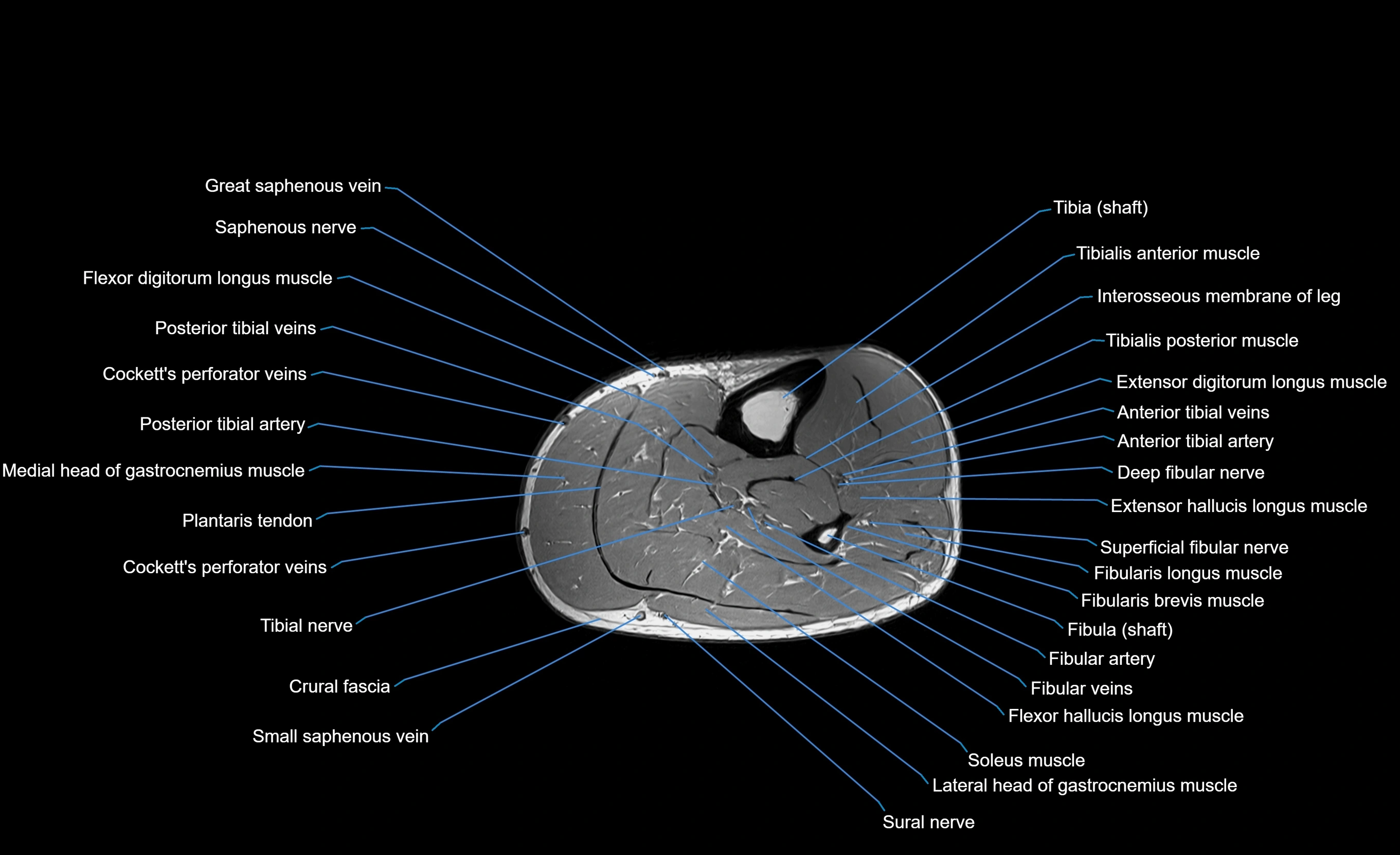MRI Lower Leg Anatomy – Normal MRI, Labeled Axial, Coronal & Sagittal ...