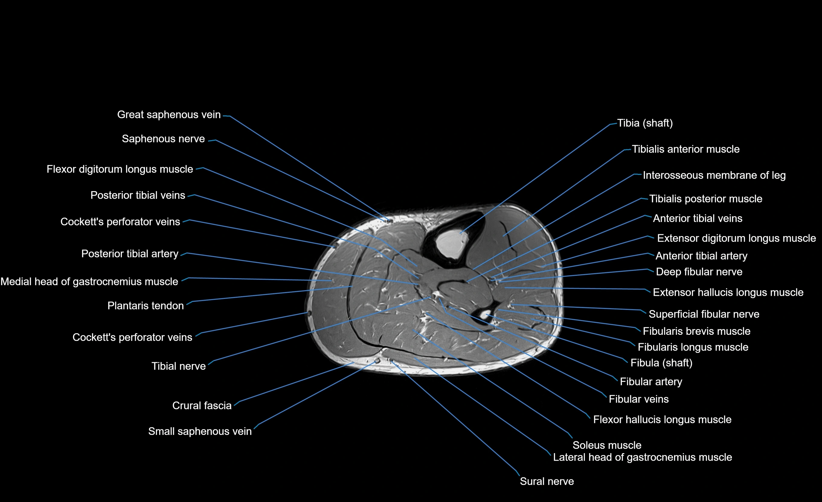 MRI Lower Leg Anatomy – Normal MRI, Labeled Axial, Coronal & Sagittal ...