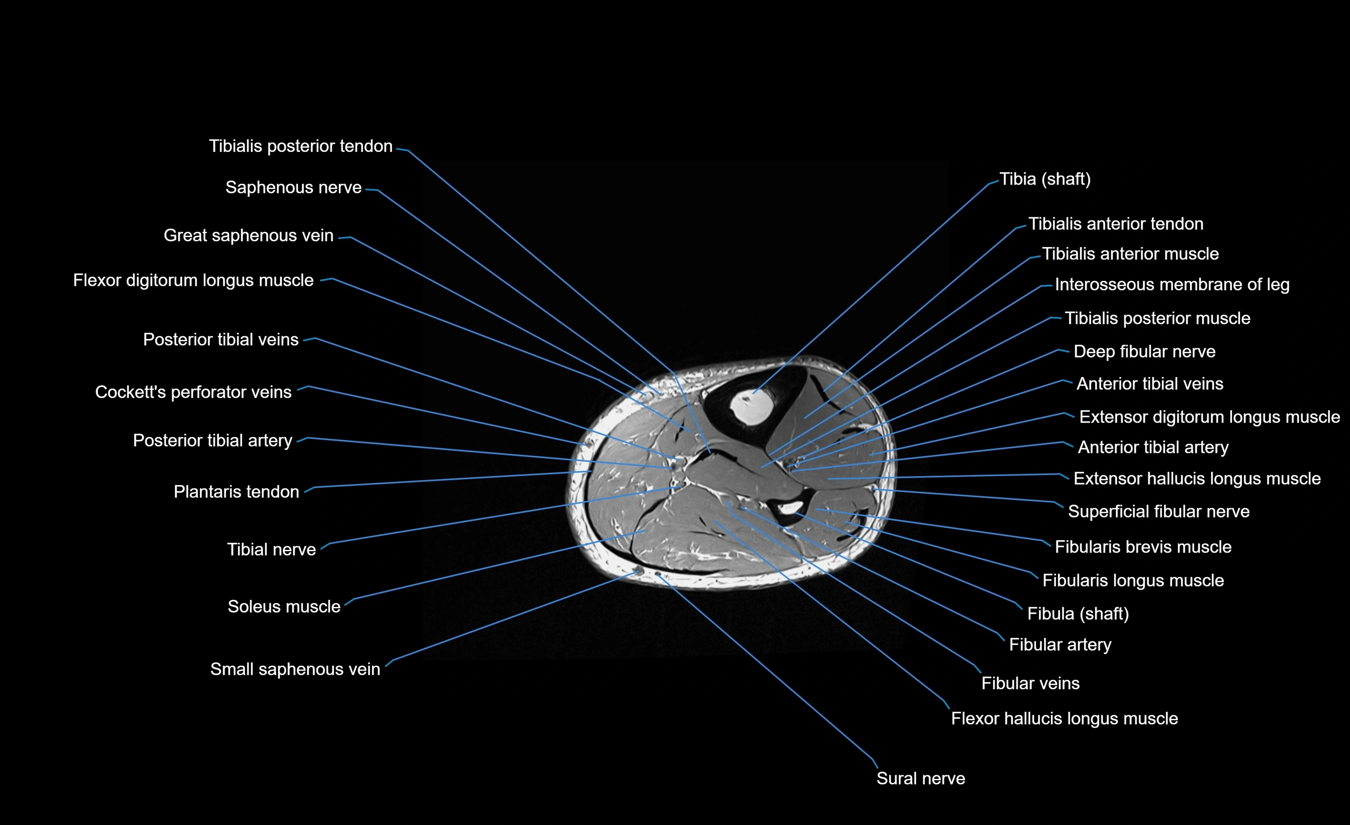 MRI Lower Leg Anatomy – Normal MRI, Labeled Axial, Coronal & Sagittal ...