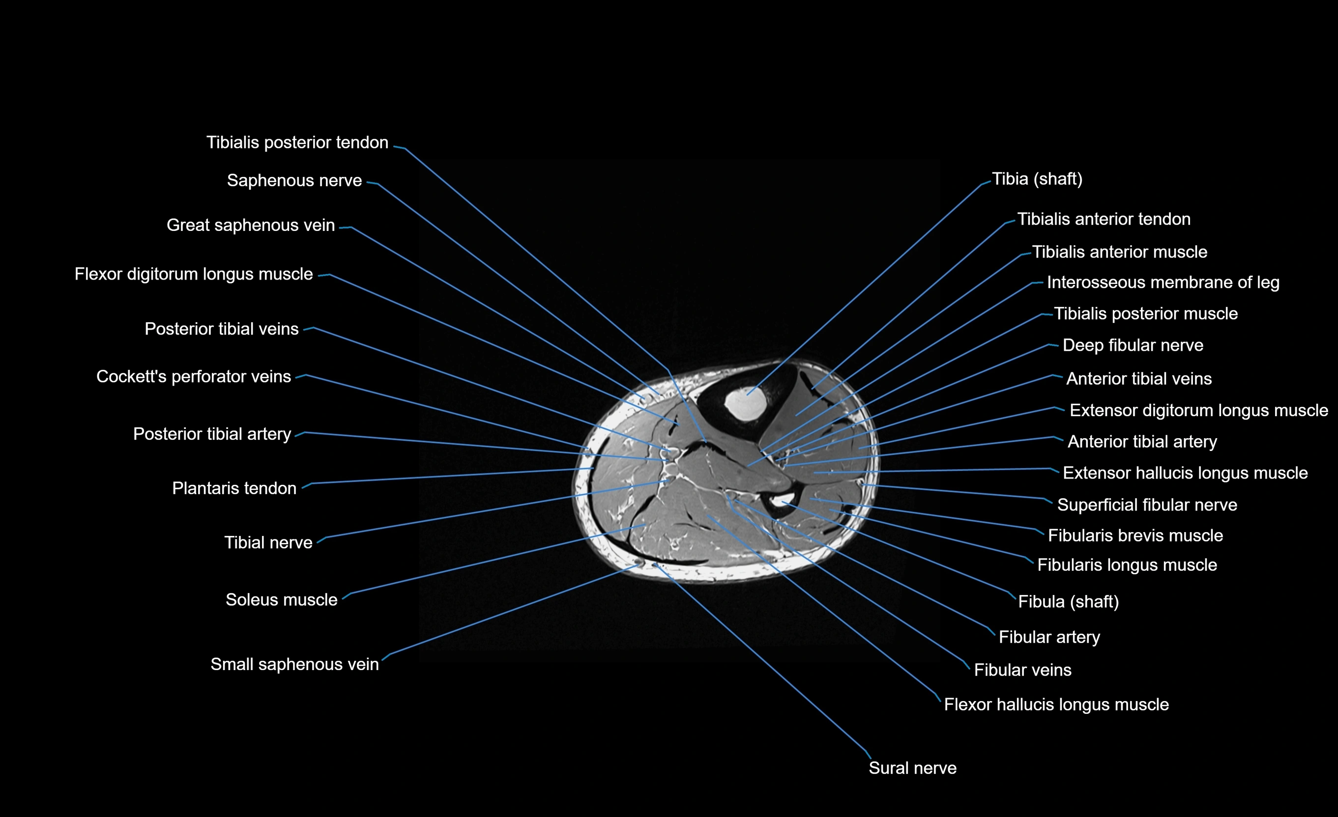 MRI Lower Leg Anatomy – Normal MRI, Labeled Axial, Coronal & Sagittal ...