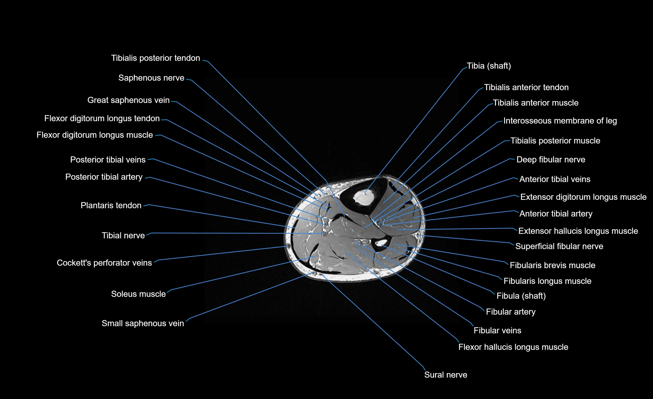 MRI Lower Leg Anatomy – Normal MRI, Labeled Axial, Coronal & Sagittal ...