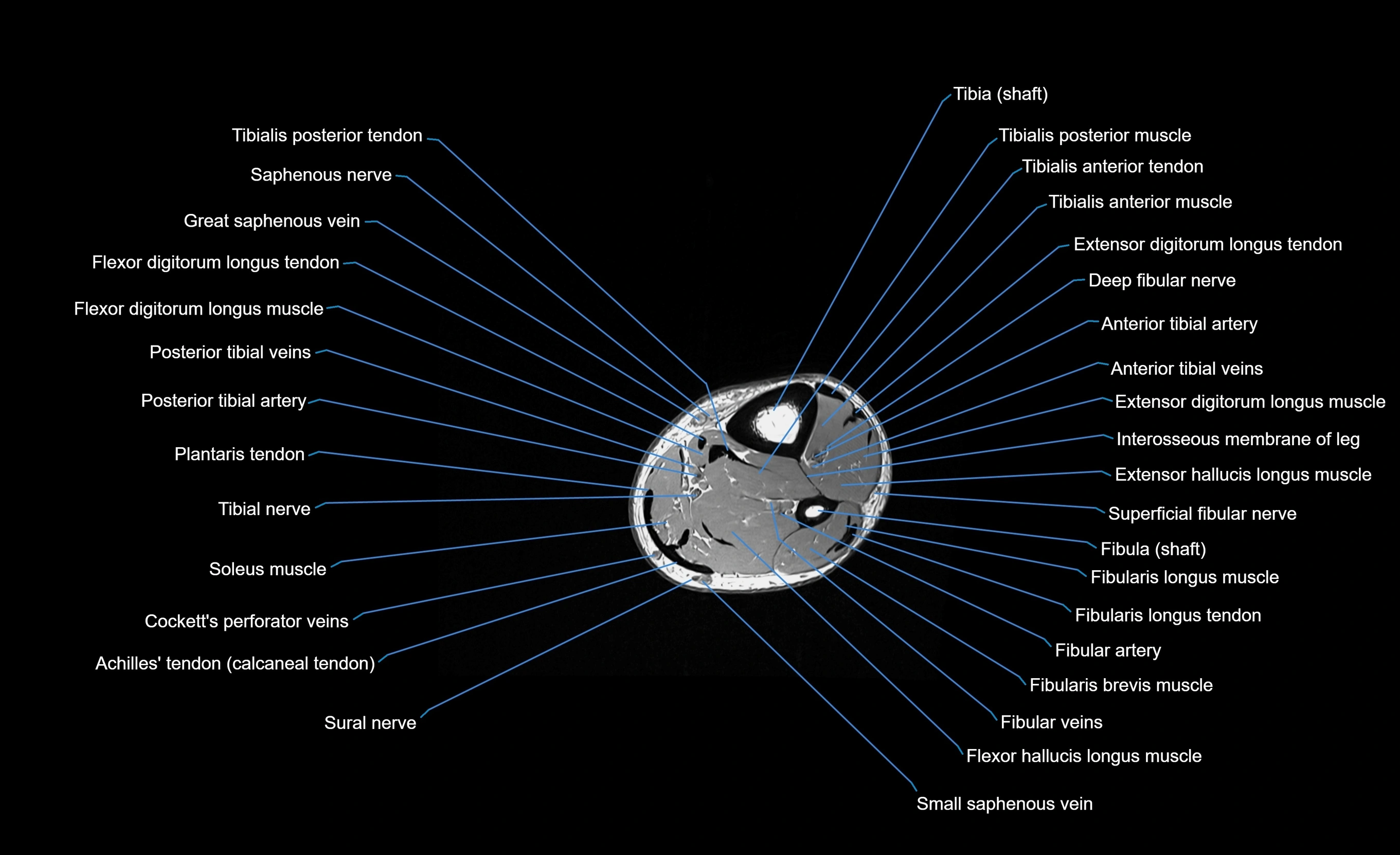 MRI Lower Leg Anatomy – Normal MRI, Labeled Axial, Coronal & Sagittal ...