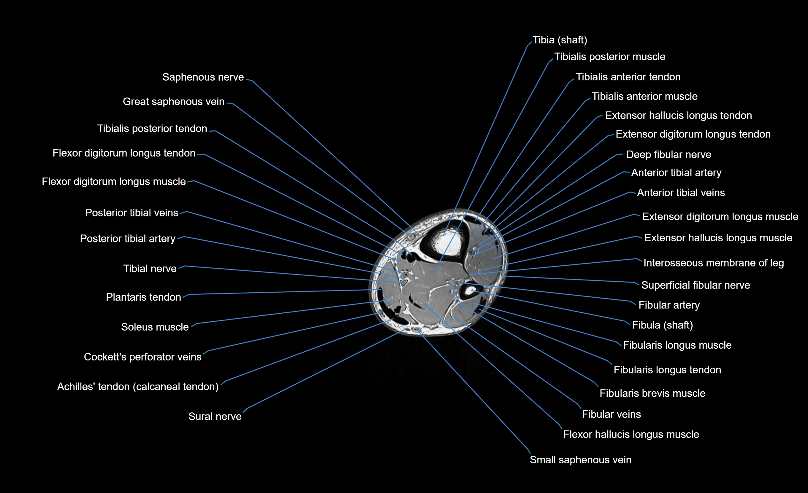 MRI Lower Leg Anatomy – Normal MRI, Labeled Axial, Coronal & Sagittal ...