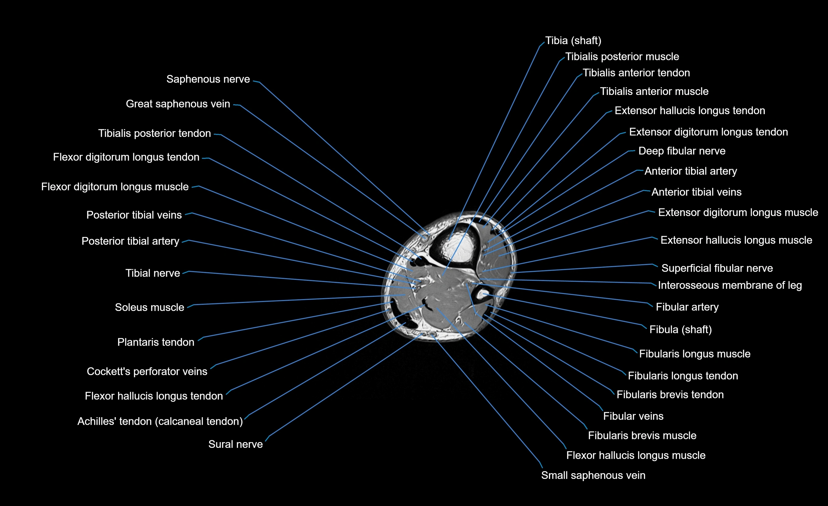 MRI Lower Leg Anatomy – Normal MRI, Labeled Axial, Coronal & Sagittal ...