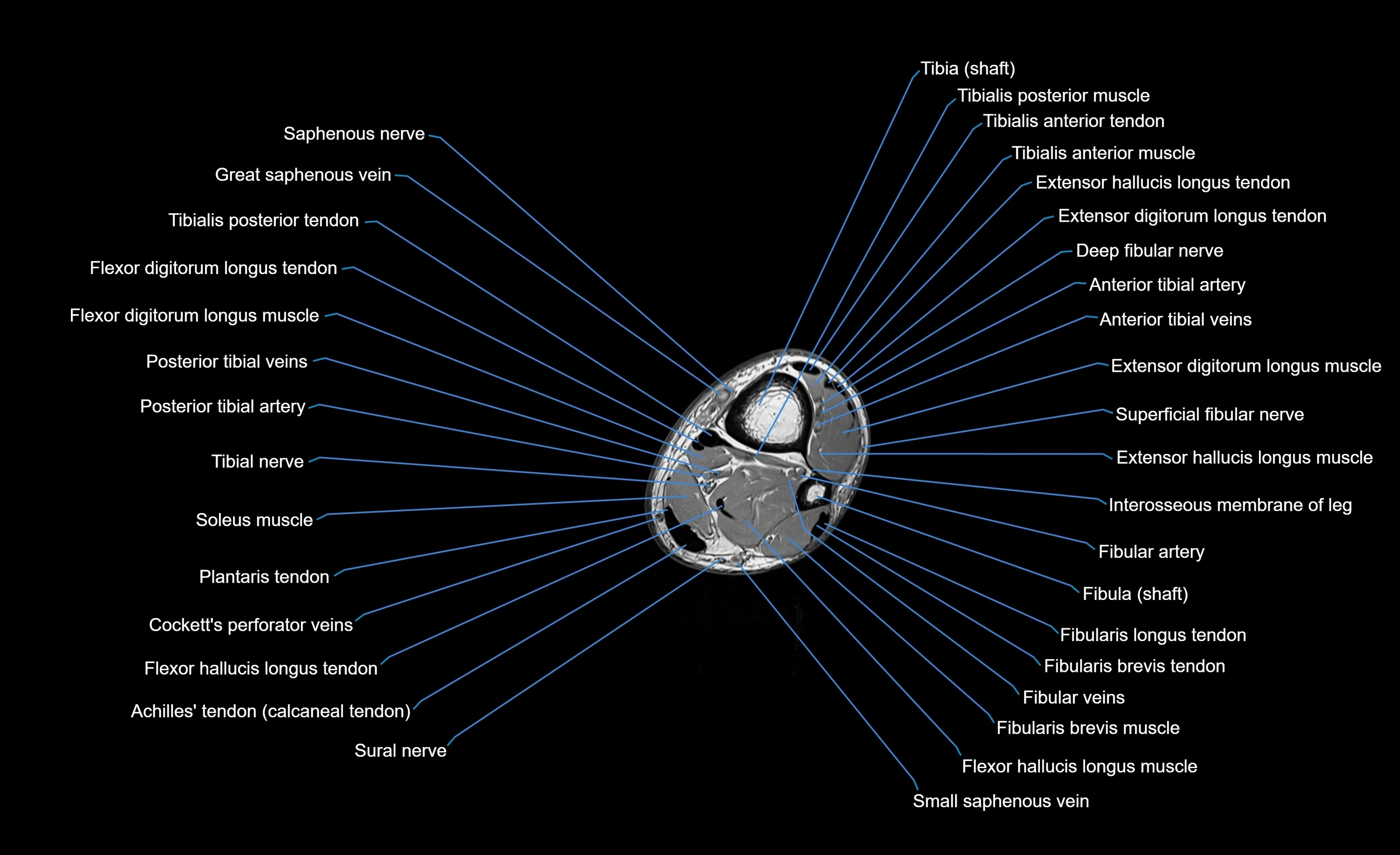 MRI Lower Leg Anatomy – Normal MRI, Labeled Axial, Coronal & Sagittal ...