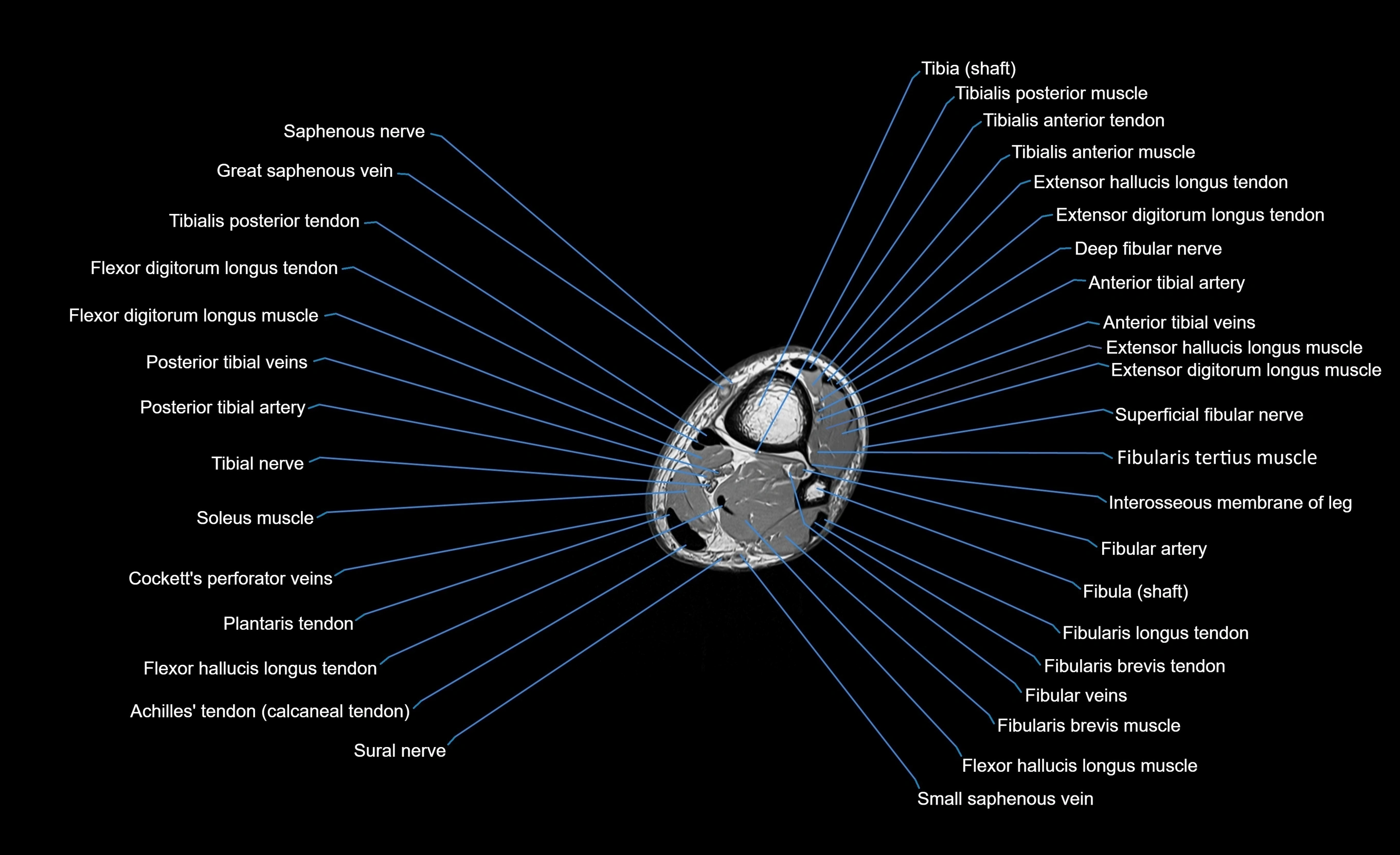 MRI Lower Leg Anatomy – Normal MRI, Labeled Axial, Coronal & Sagittal ...