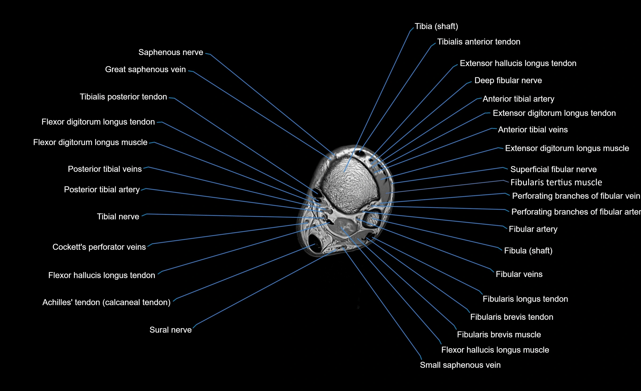 MRI Lower Leg Anatomy – Normal MRI, Labeled Axial, Coronal & Sagittal ...