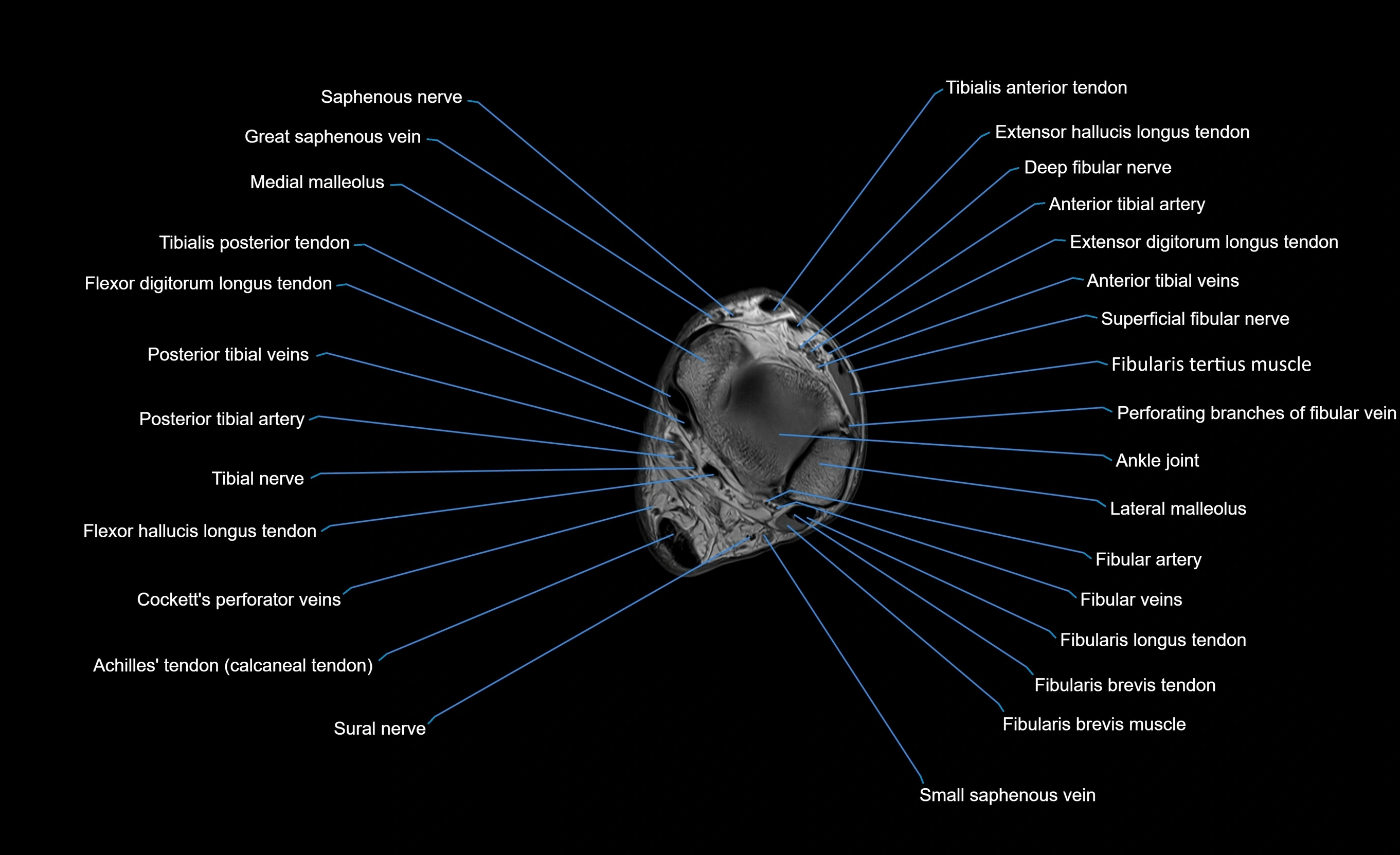 MRI Lower Leg Anatomy – Normal MRI, Labeled Axial, Coronal & Sagittal ...