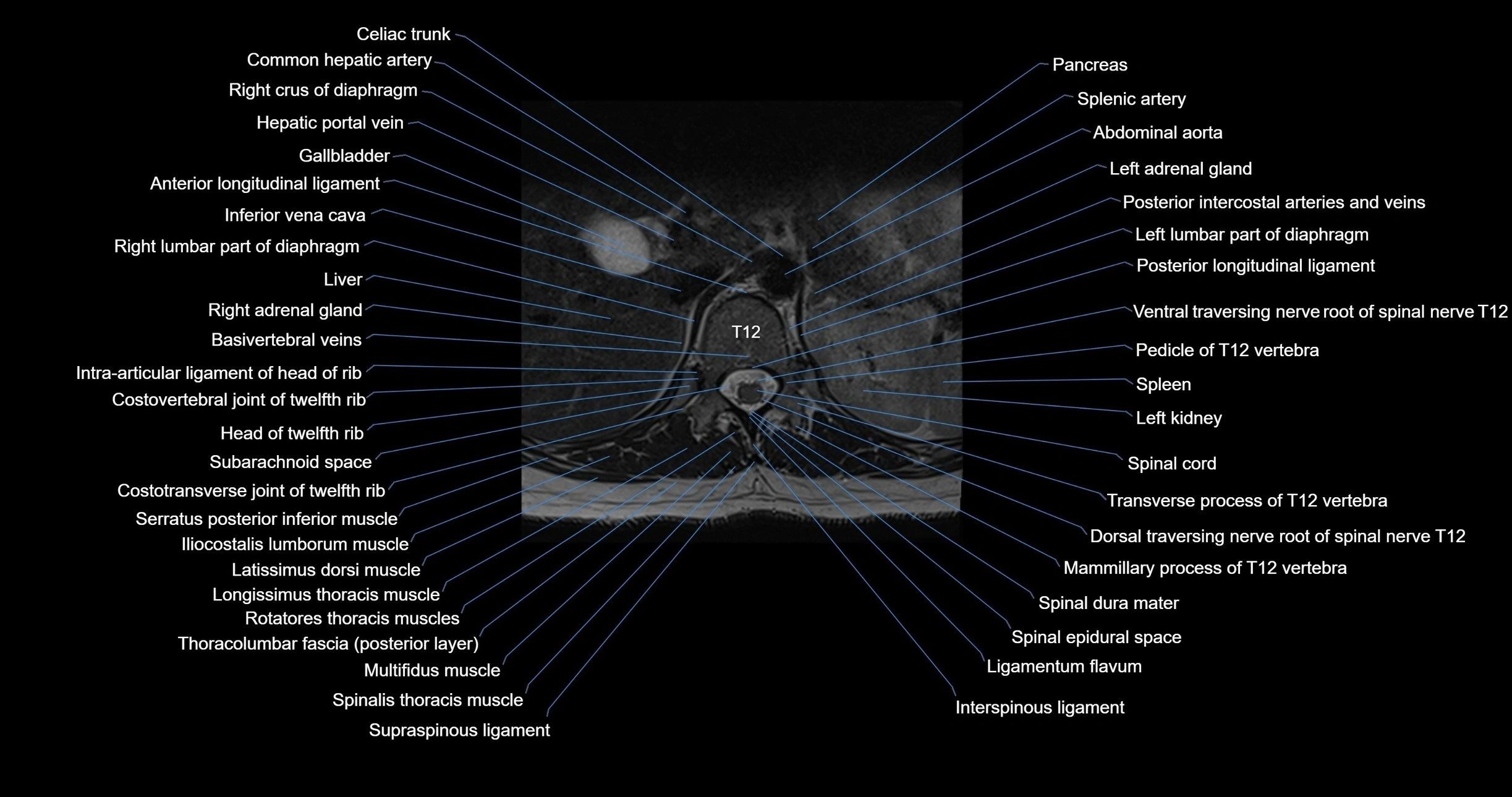 MRI Lumbosacral Spine Anatomy – Axial, Coronal & Sagittal Labeled Images