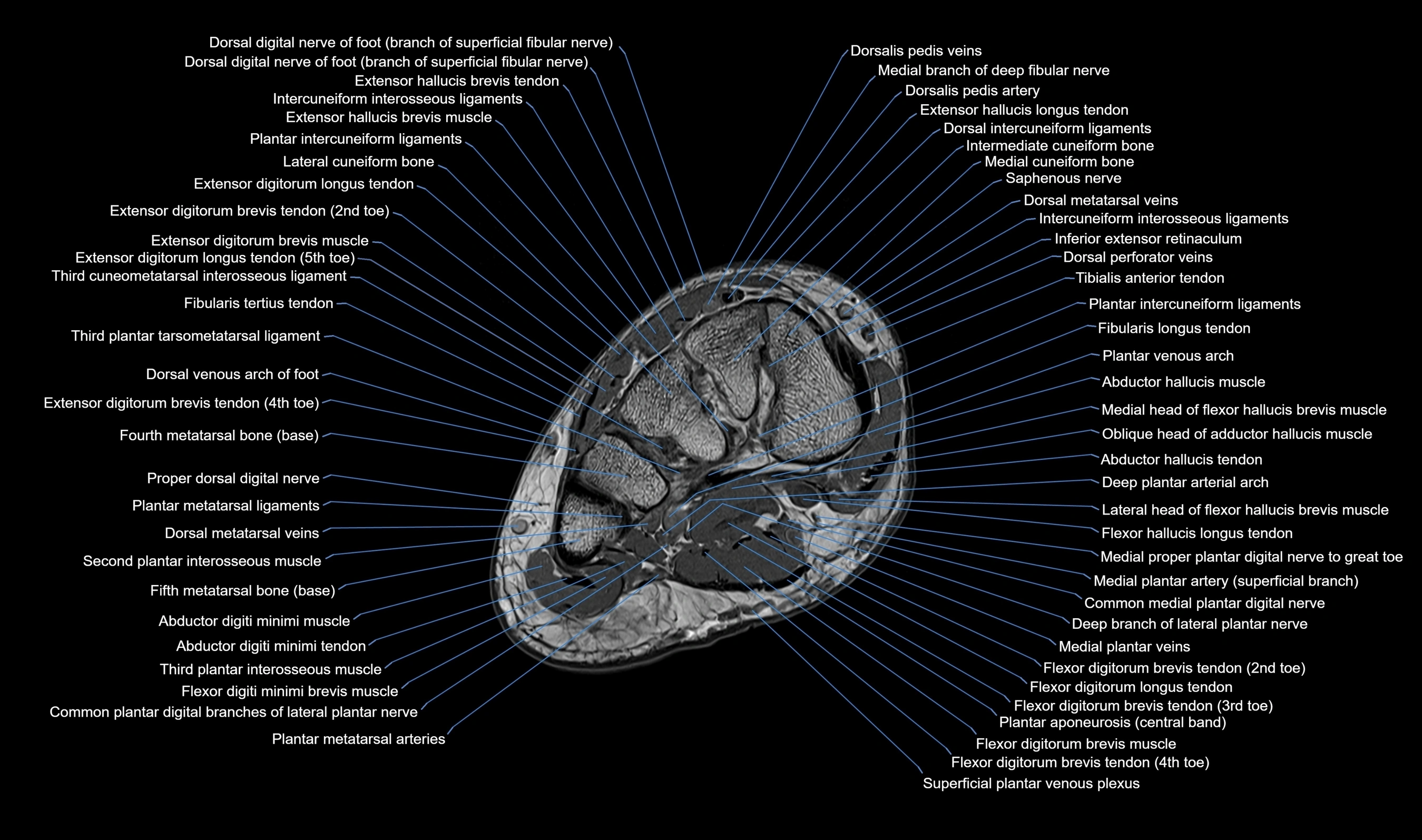 Midfoot Radiology MRI Midfoot Anatomy – Axial, Coronal & Sagittal Labeled Cross-Section ...