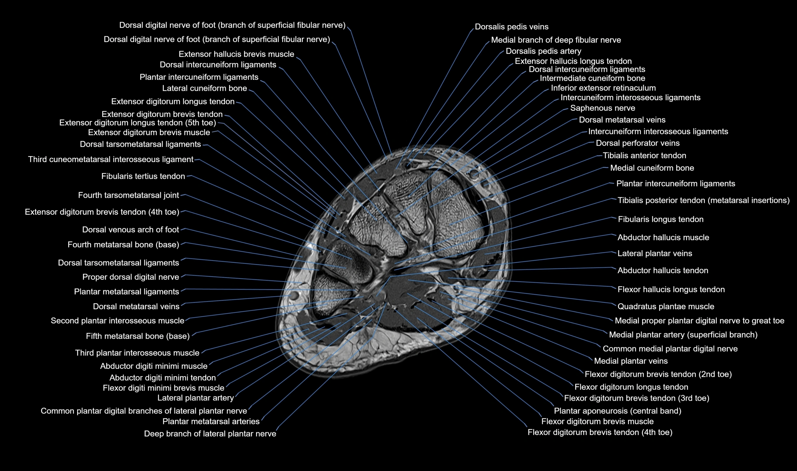 Midfoot Radiology MRI Midfoot Anatomy – Axial, Coronal & Sagittal Labeled Cross-Section ...
