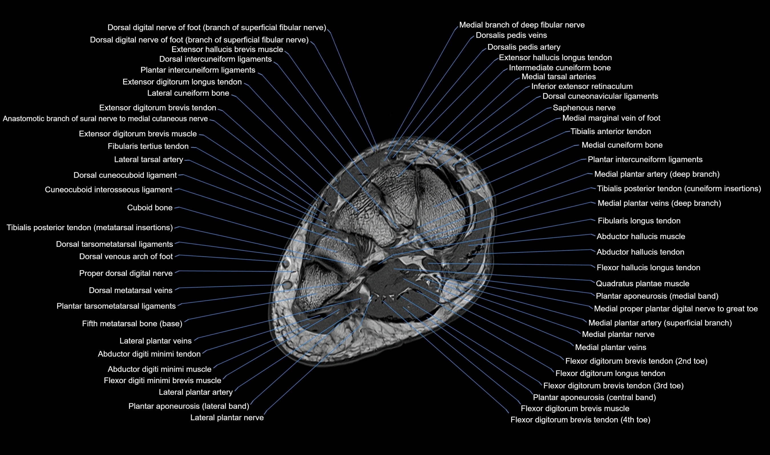 Midfoot Radiology MRI Midfoot Anatomy – Axial, Coronal & Sagittal Labeled Cross-Section ...