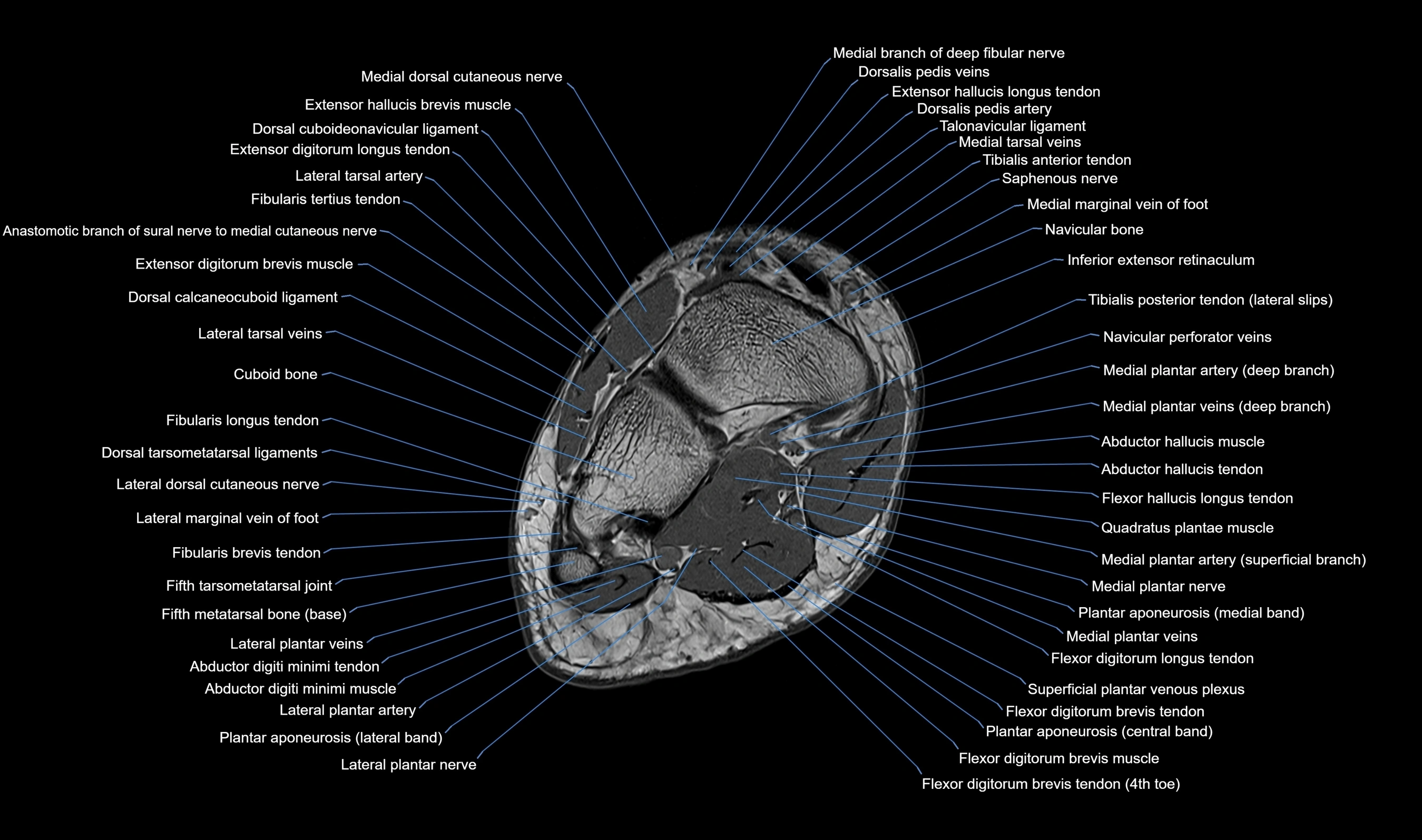 Midfoot Radiology MRI Midfoot Anatomy – Axial, Coronal & Sagittal Labeled Cross-Section ...