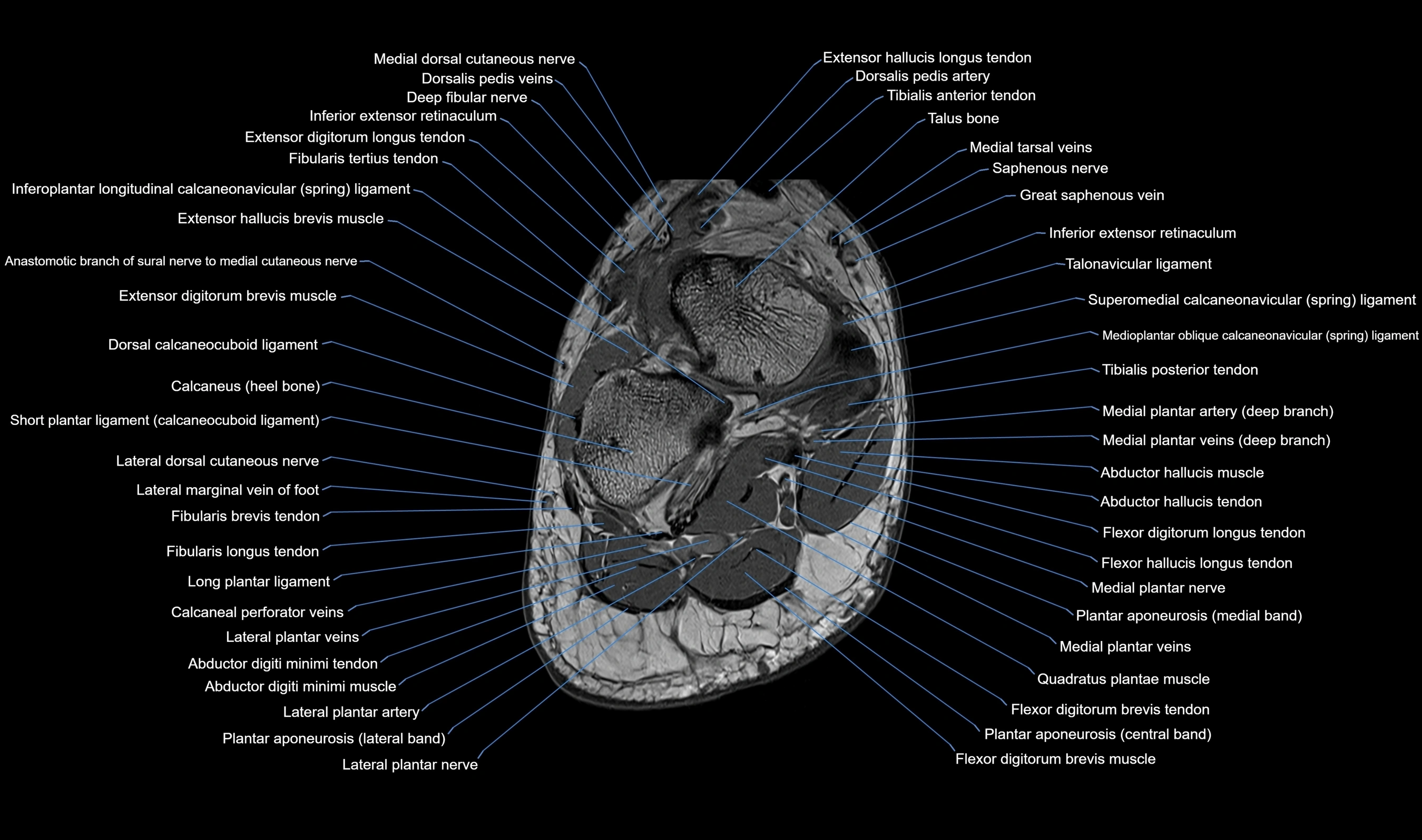 Midfoot Radiology MRI Midfoot Anatomy – Axial, Coronal & Sagittal Labeled Cross-Section ...