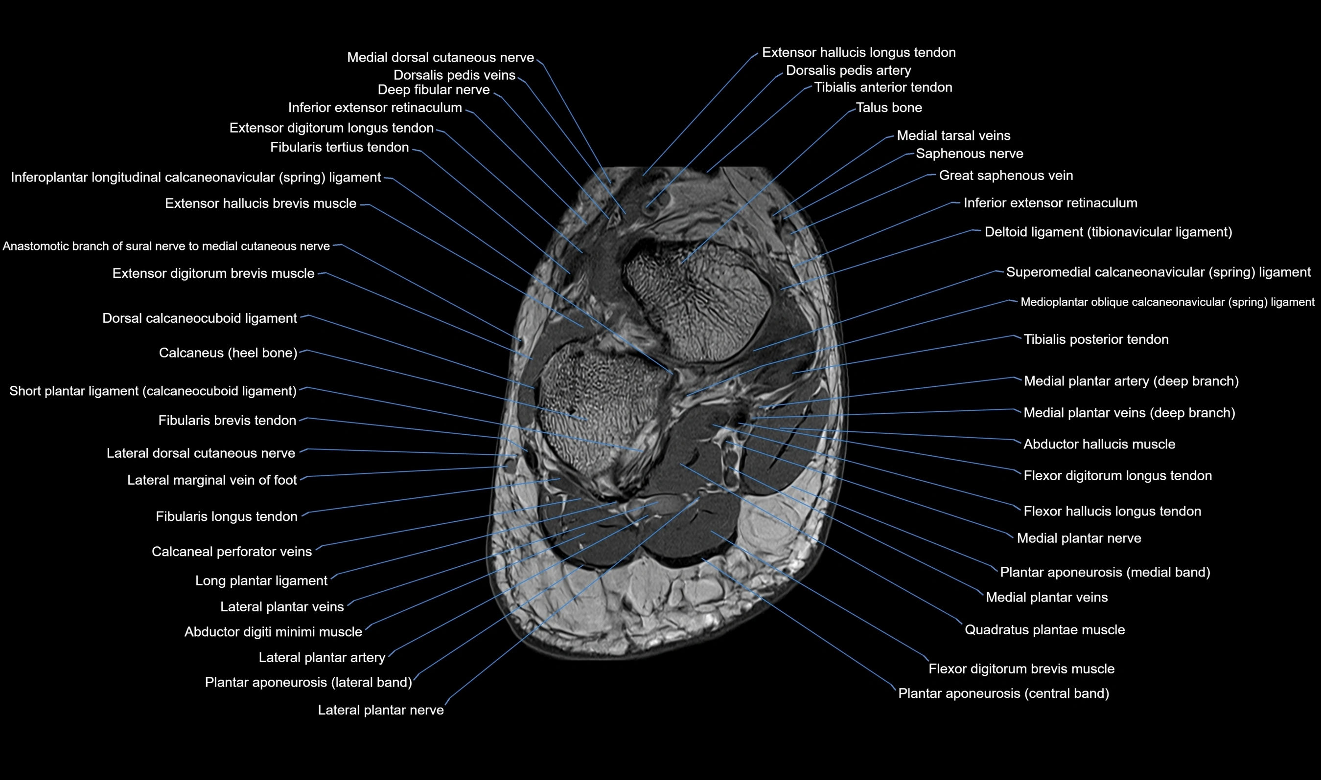 MRI Midfoot Anatomy – Axial, Coronal & Sagittal Labeled Cross-Section ...