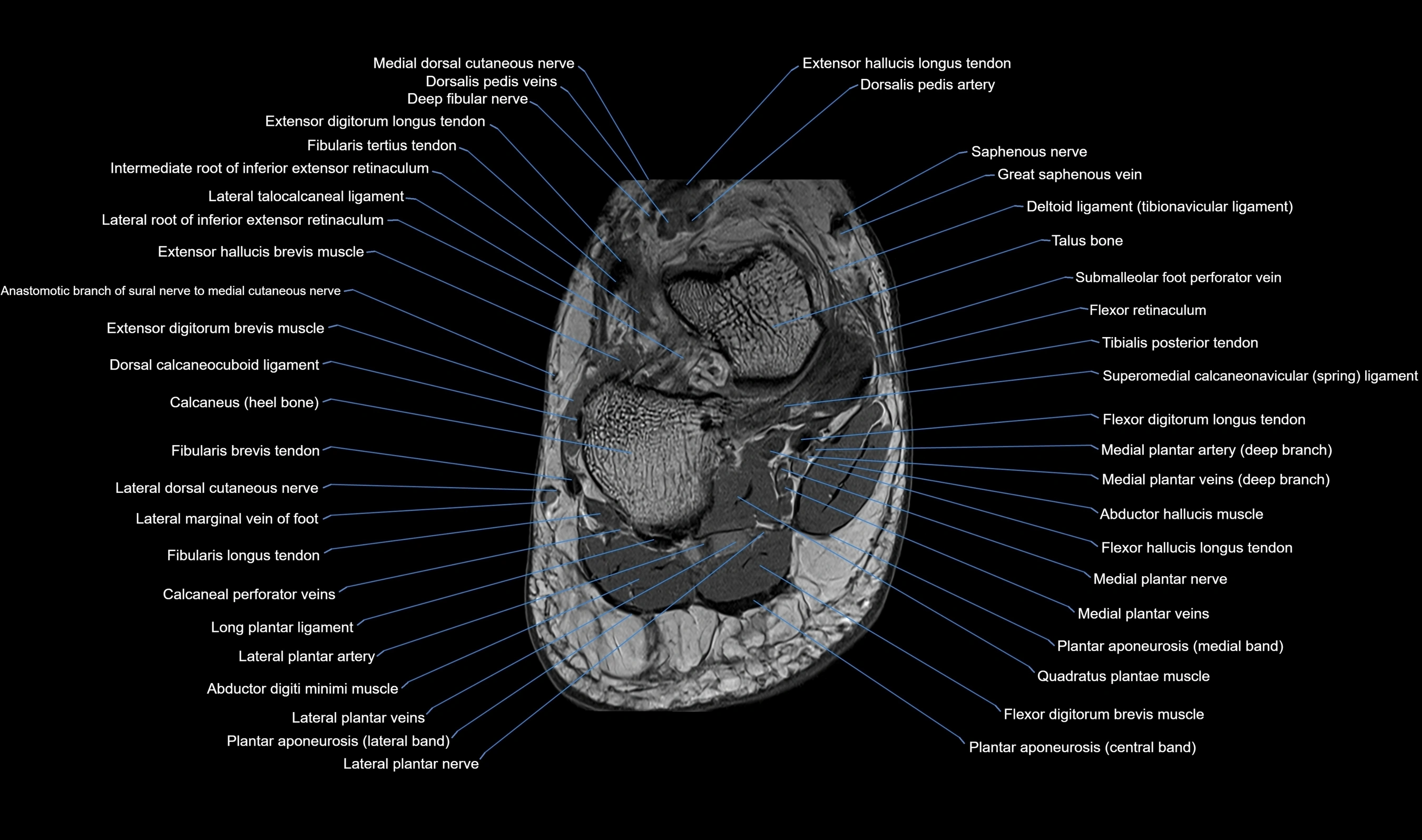 Midfoot Radiology MRI Midfoot Anatomy – Axial, Coronal & Sagittal Labeled Cross-Section ...