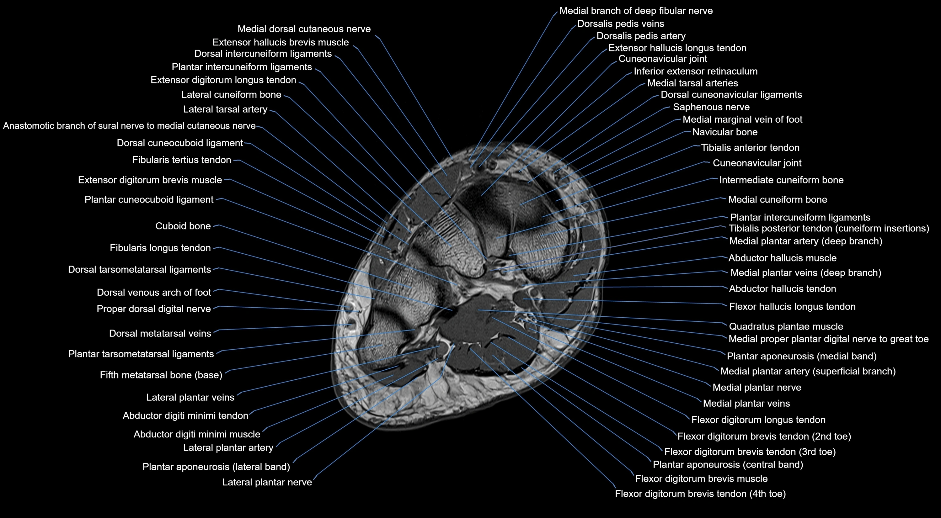 Midfoot Radiology MRI Midfoot Anatomy – Axial, Coronal & Sagittal Labeled Cross-Section ...