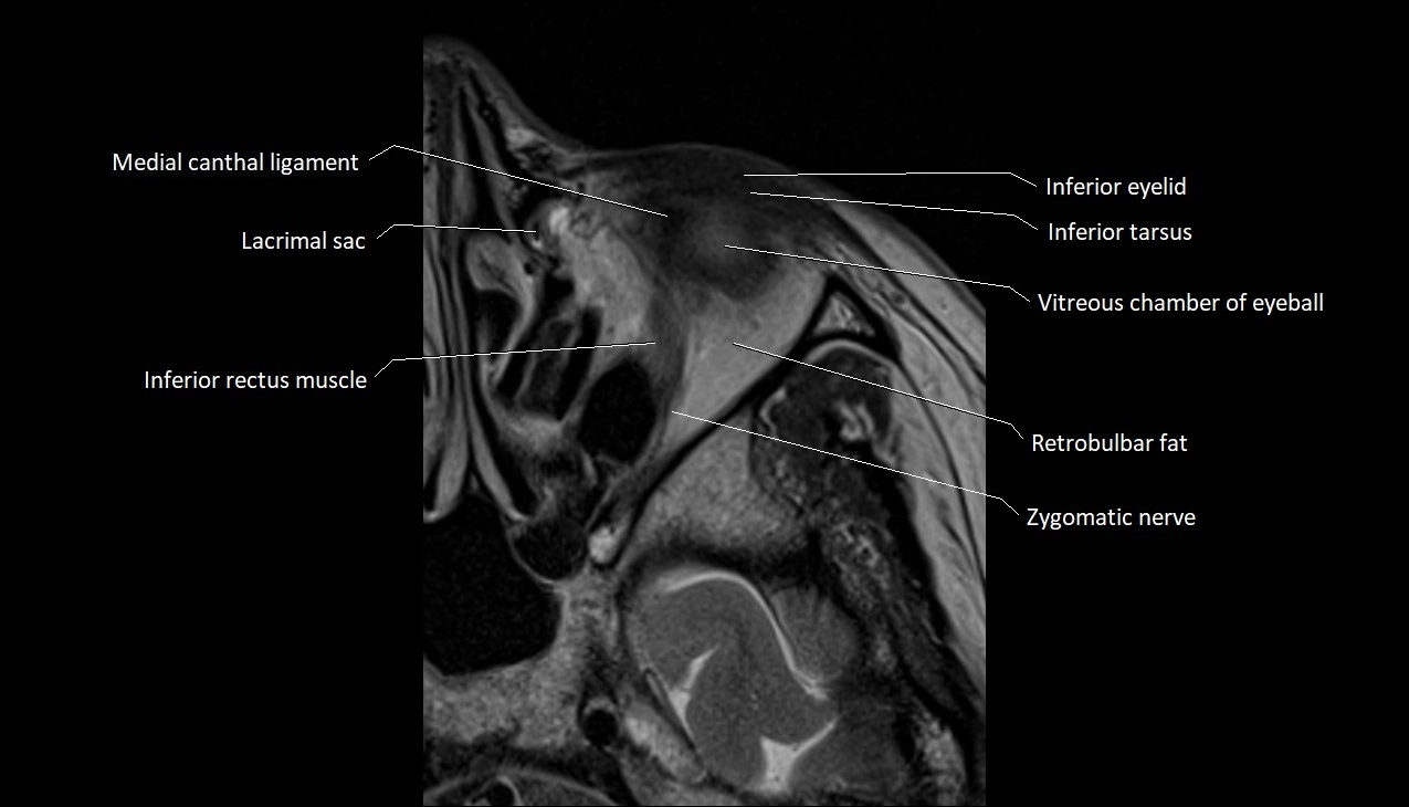 Orbits Mri Master MRI Orbits Anatomy – Axial, Coronal & Sagittal Labeled Images