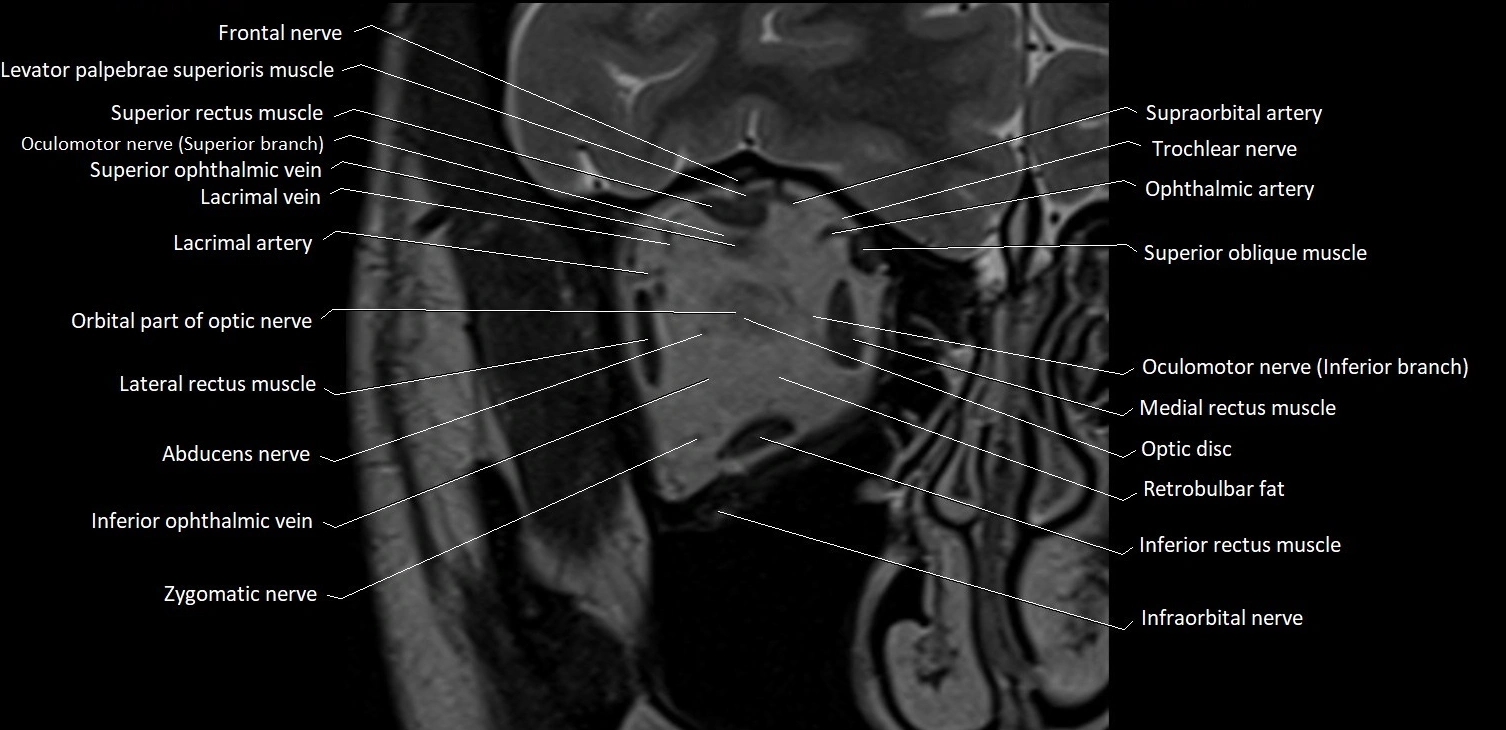 Orbits Mri Master MRI Orbits Anatomy – Axial, Coronal & Sagittal Labeled Images