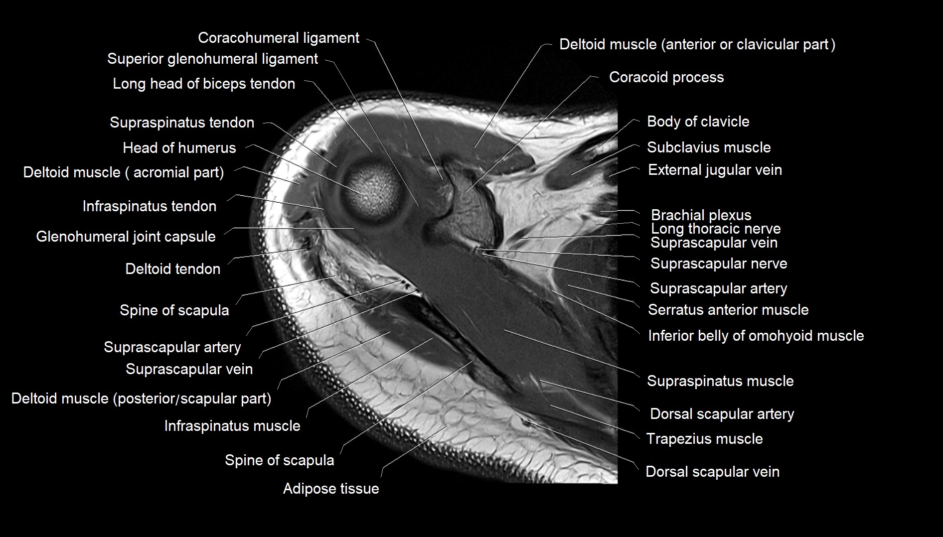 Shoulder Geode MRI Shoulder Anatomy – Labeled Axial, Coronal & Sagittal Rotator Cuff ...
