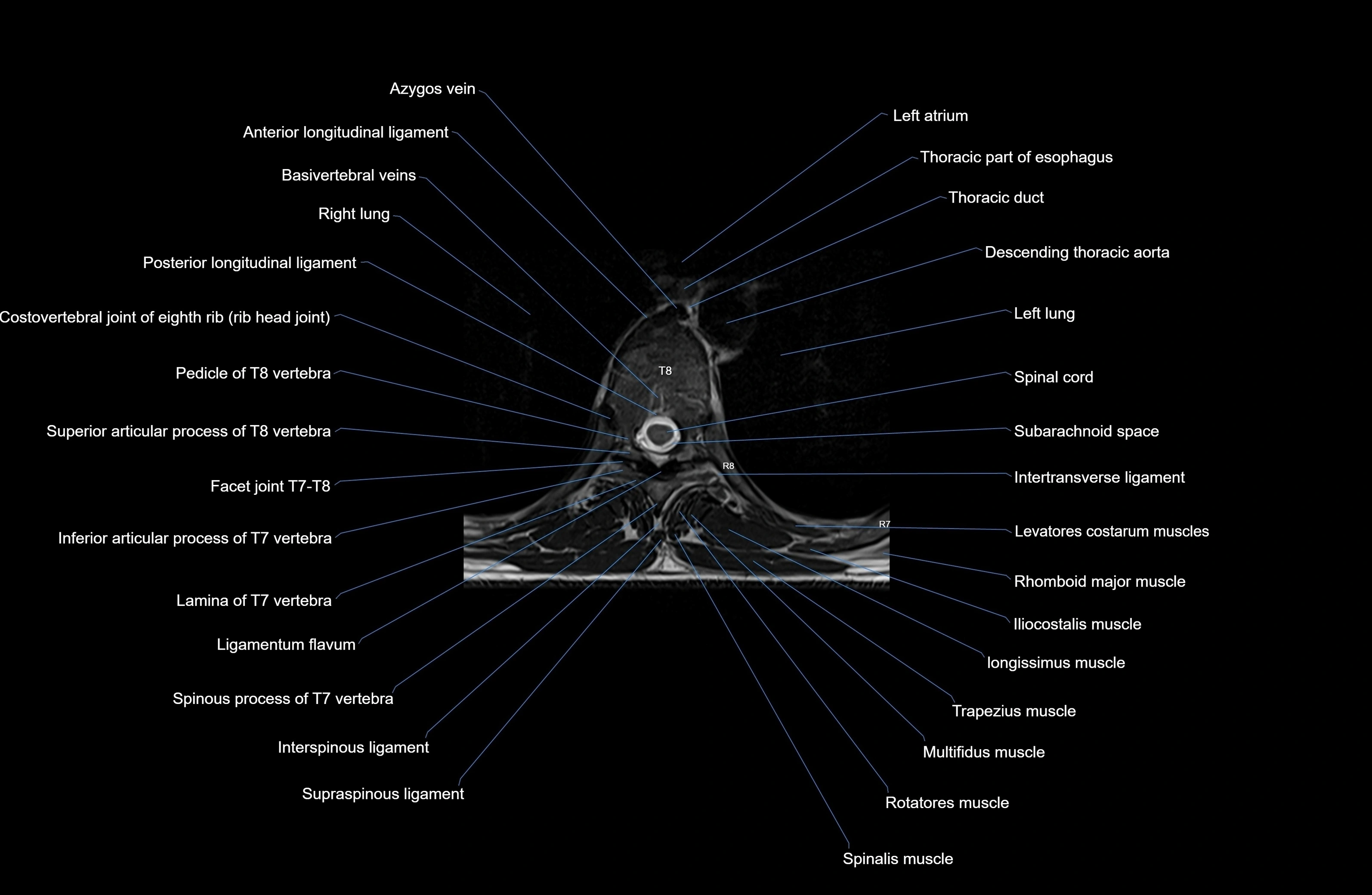 MRI Thoracic Spine Anatomy – Labeled Axial, Sagittal & Coronal Sections