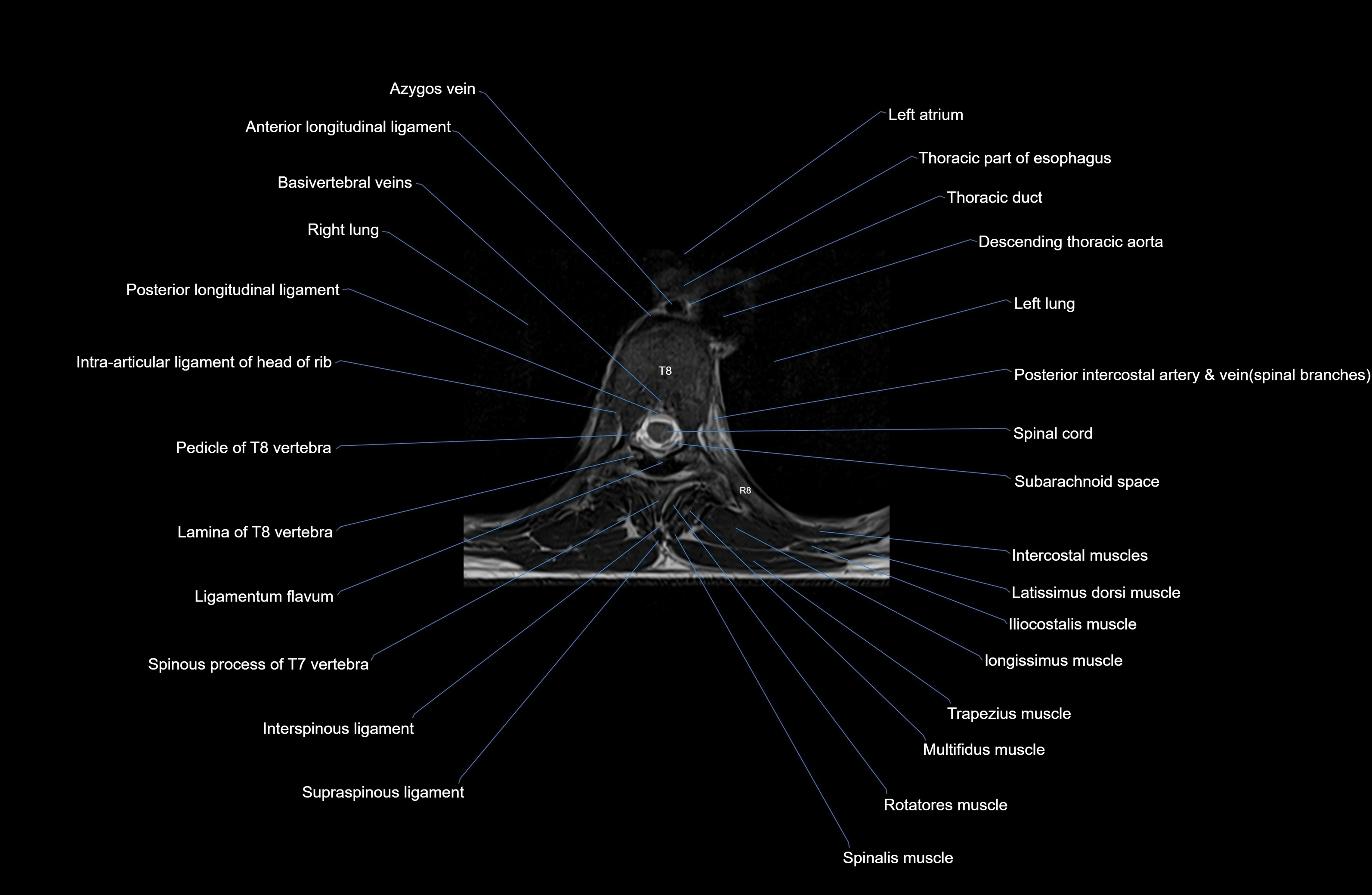 MRI Thoracic Spine Anatomy – Labeled Axial, Sagittal & Coronal Sections