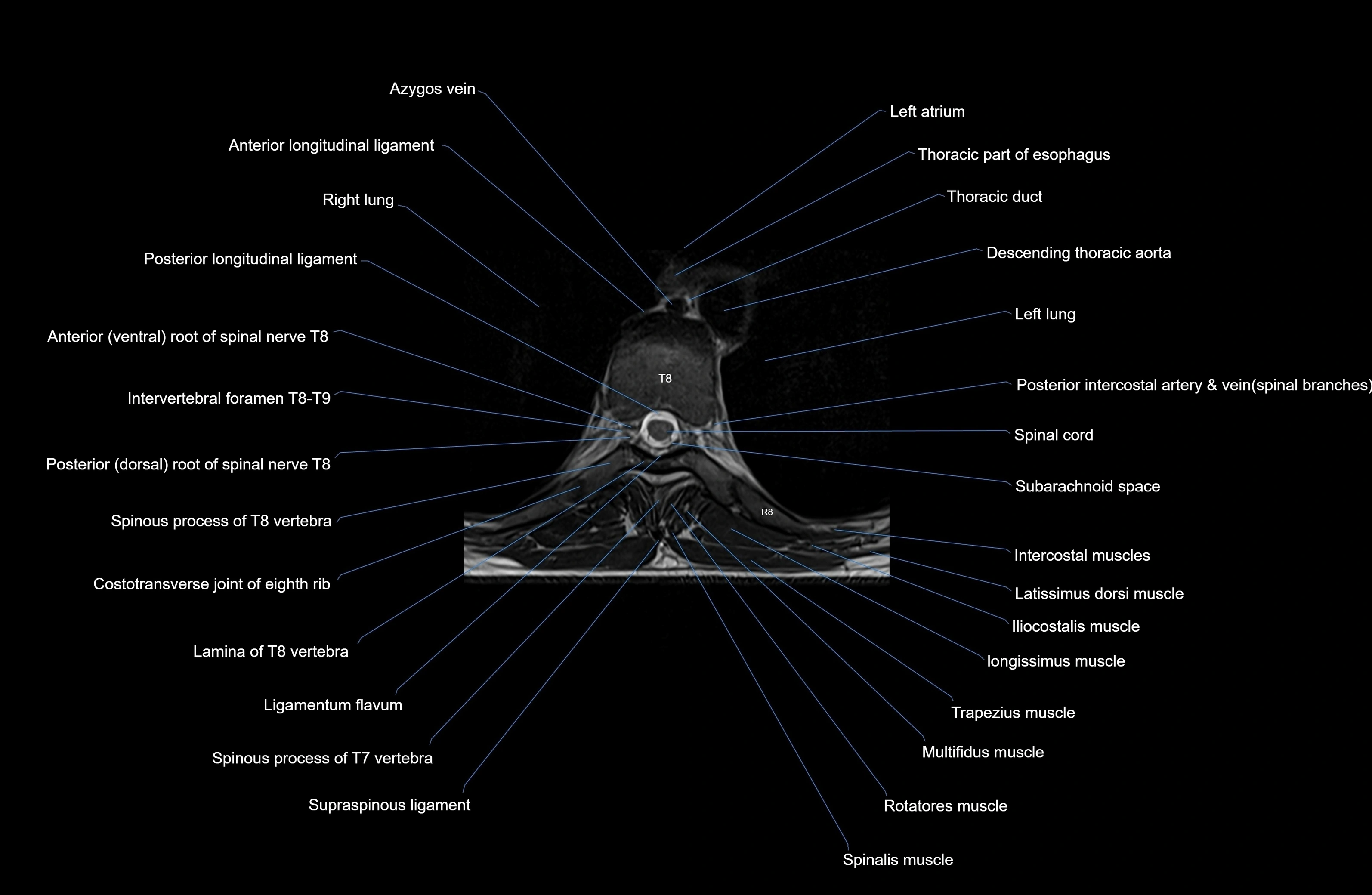 MRI Thoracic Spine Anatomy – Labeled Axial, Sagittal & Coronal Sections