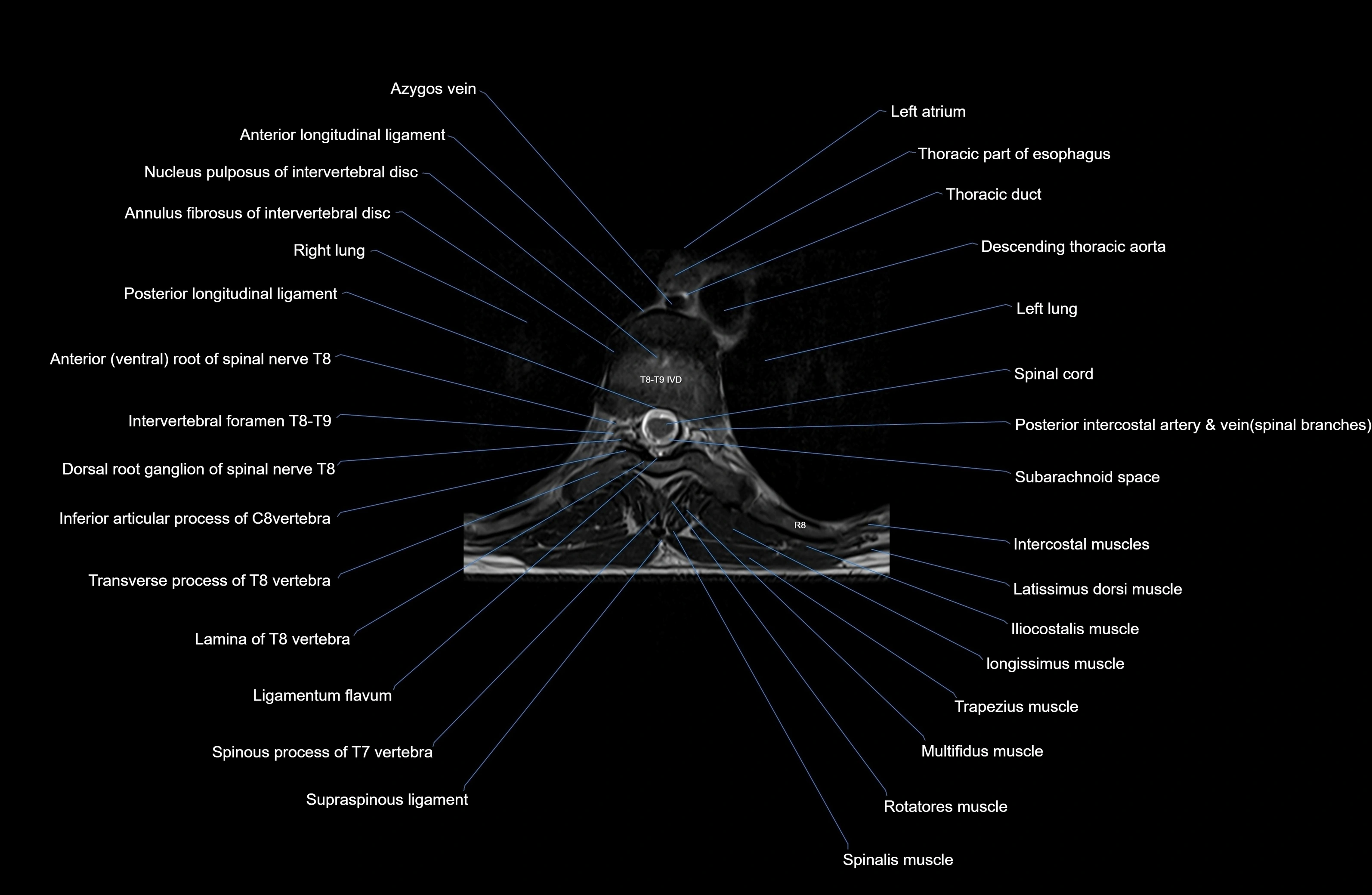 MRI Thoracic Spine Anatomy – Labeled Axial, Sagittal & Coronal Sections