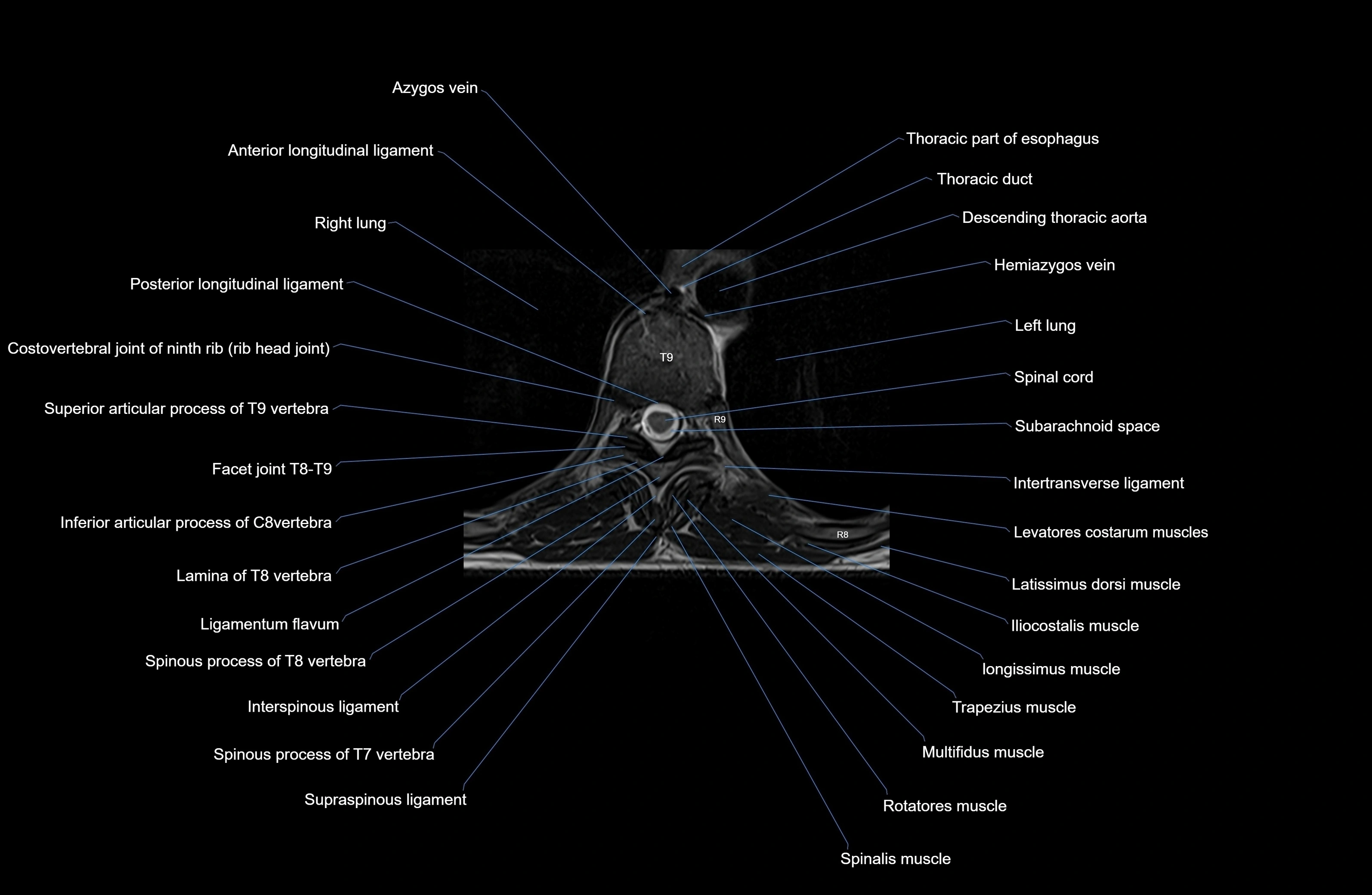 MRI Thoracic Spine Anatomy – Labeled Axial, Sagittal & Coronal Sections