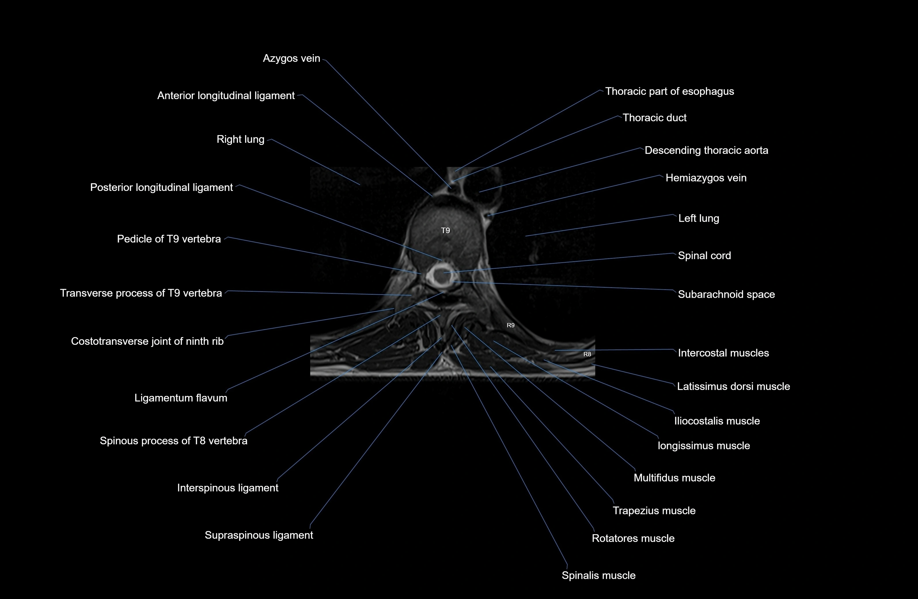 MRI Thoracic Spine Anatomy – Labeled Axial, Sagittal & Coronal Sections