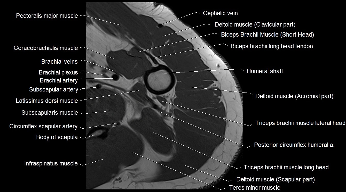 MRI Upper Arm Anatomy – Labeled Axial, Coronal & Sagittal MRI Cross ...