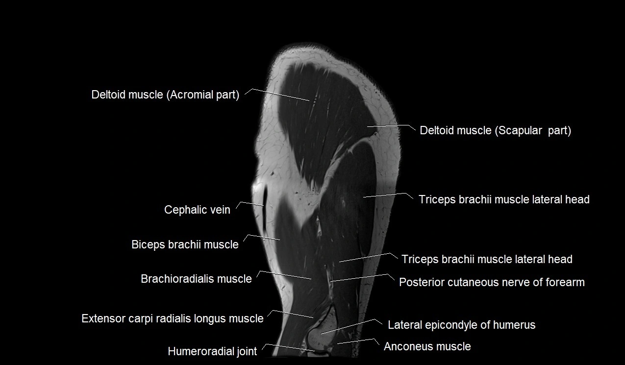 MRI Upper Arm Anatomy – Labeled Axial, Coronal & Sagittal MRI Cross ...