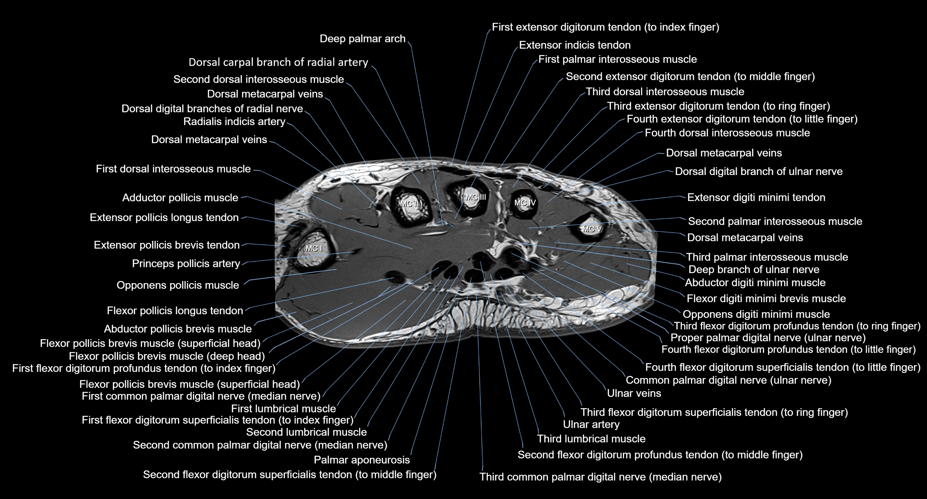 MRI Wrist Anatomy – Labeled Axial, Coronal & Sagittal Images