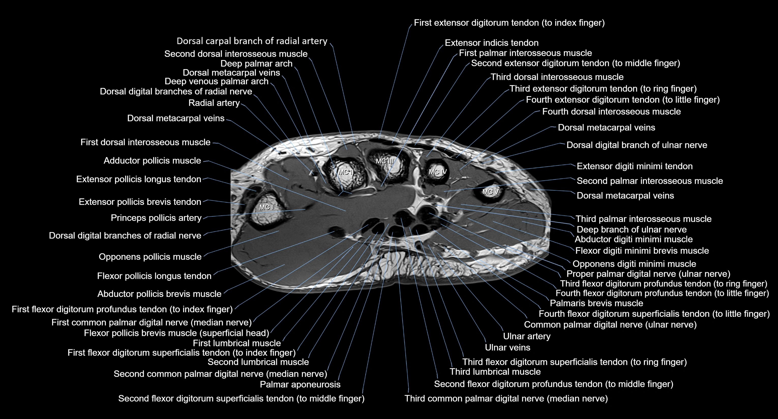 MRI Wrist Anatomy – Labeled Axial, Coronal & Sagittal Images