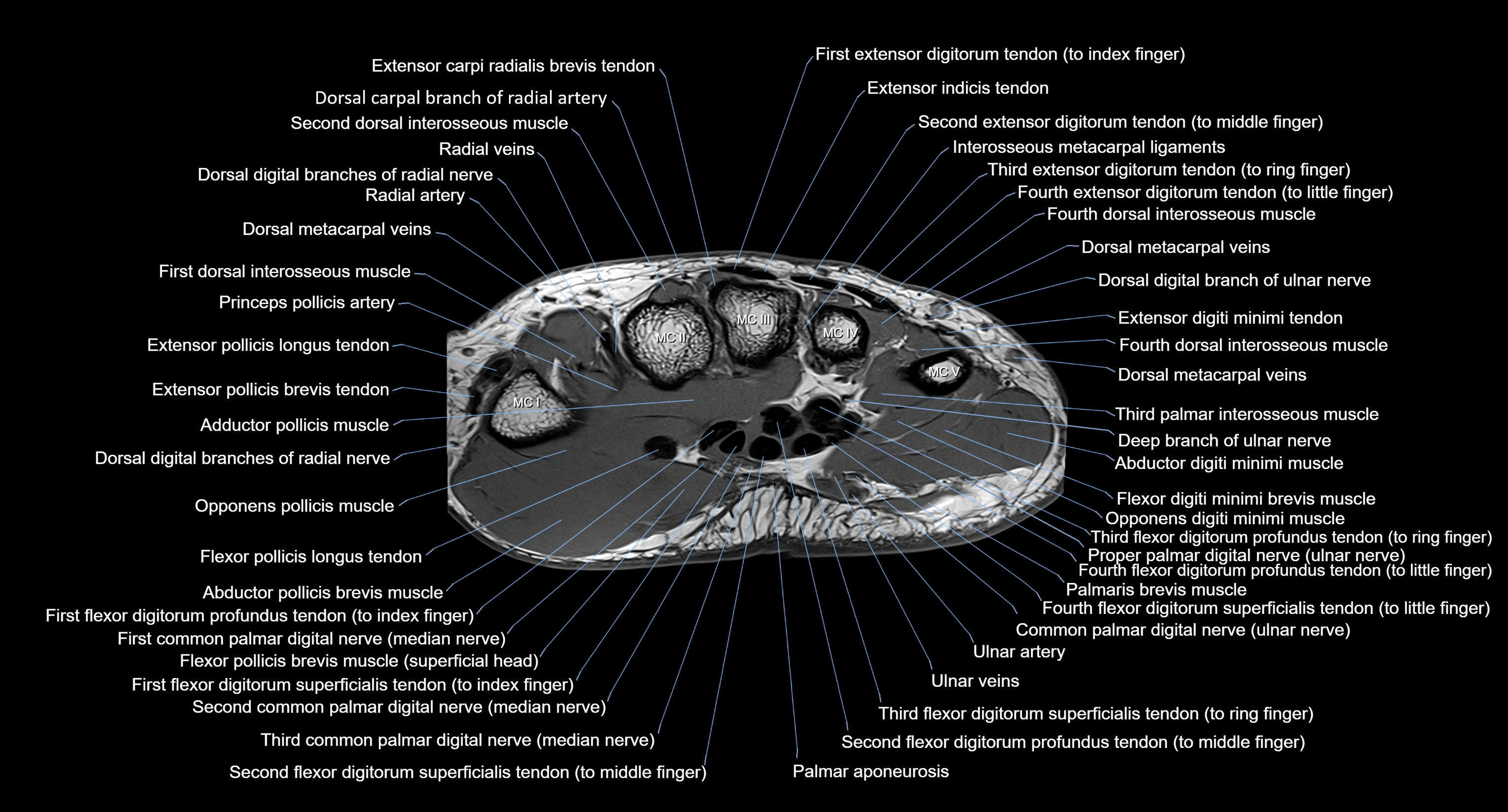 MRI Wrist Anatomy – Labeled Axial, Coronal & Sagittal Images