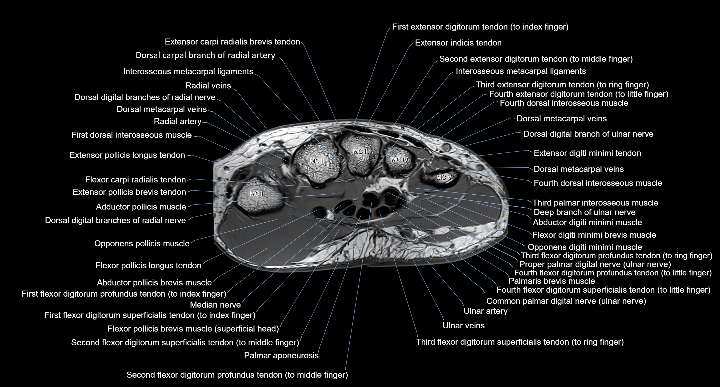 MRI Wrist Anatomy – Labeled Axial, Coronal & Sagittal Images